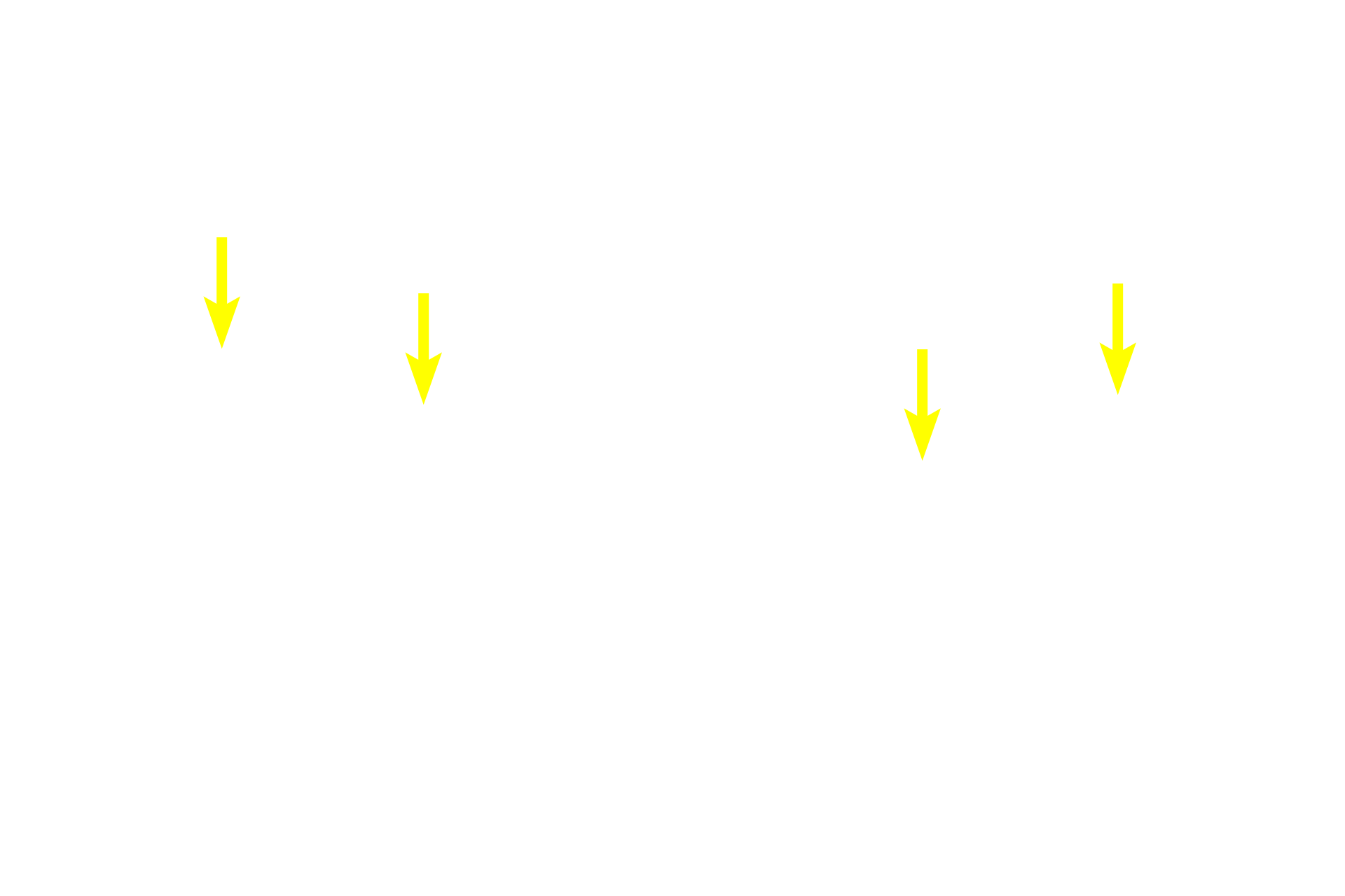 Chromosomes <p>These images of the lining of the esophagus show two cells with clear evidence of cytokinesis underway. For the most part, the chromosomes, which have fully migrated into the two eventual daughter cells, are still highly condensed; however, the cell in the right panel shows initial stages of nuclear envelope reformation. Esophageal epithelium 1000x</p>

