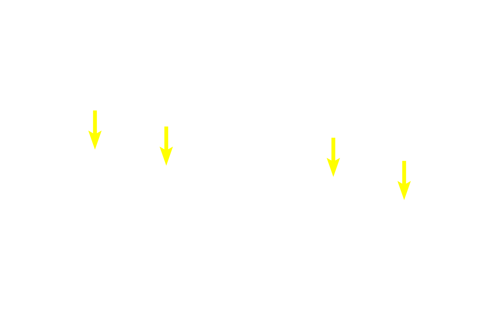 Chromsomes (decondensing) <p>These images show two cells in the lining epithelium of the esophagus in the final stages of cytokinesis and telophase.  In the left panel, the daughter cells are still attached by a thin connection, whereas in the right panel, the daughter cells are completely separate.  The chromosomes are decondensing and the nuclear envelopes are reforming. Esophageal epithelium 1000x</p>
