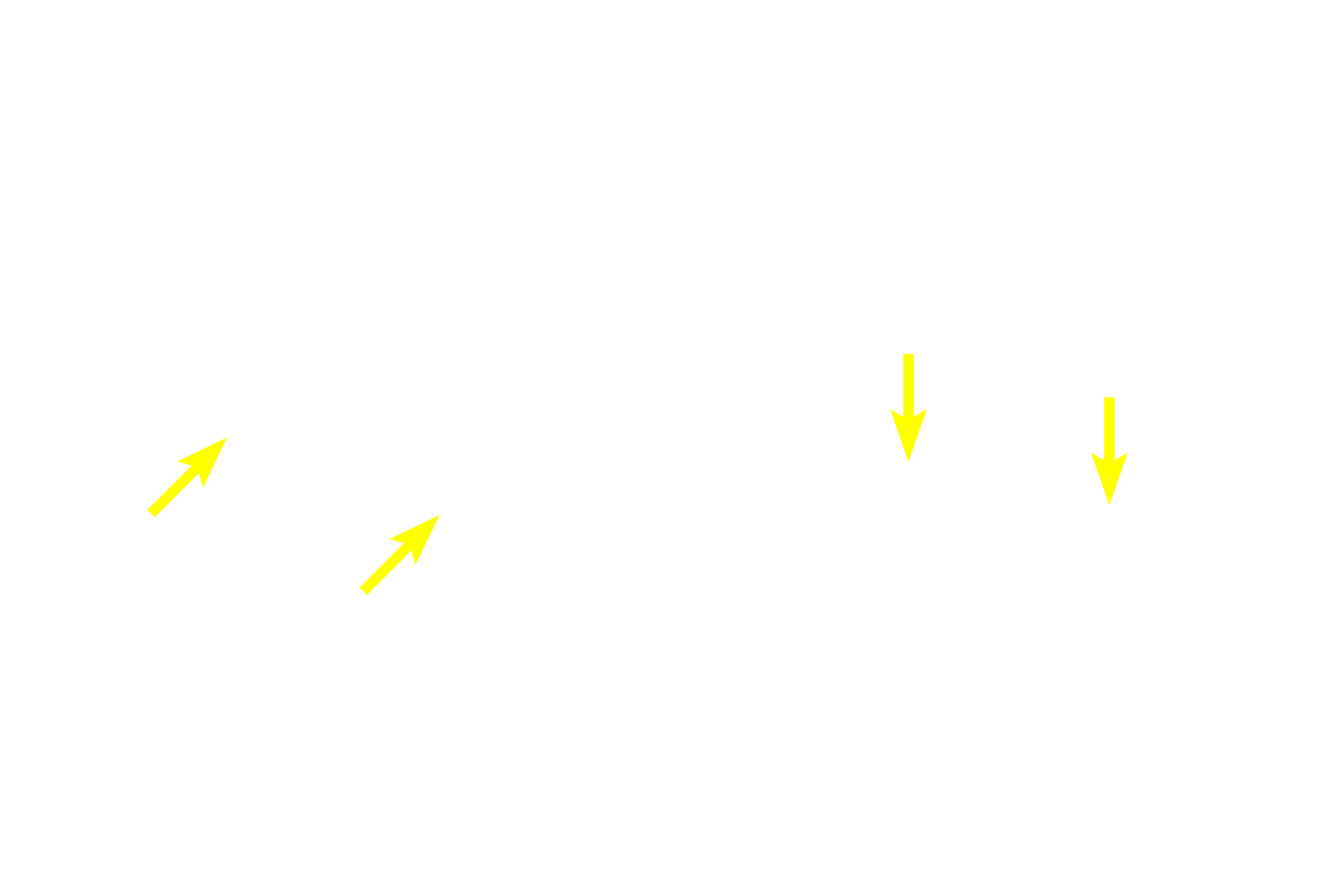 Nuclear envelope (reforming) <p>These images show two cells in the lining epithelium of the esophagus in the final stages of cytokinesis and telophase.  In the left panel, the daughter cells are still attached by a thin connection, whereas in the right panel, the daughter cells are completely separate.  The chromosomes are decondensing and the nuclear envelopes are reforming. Esophageal epithelium 1000x</p>
