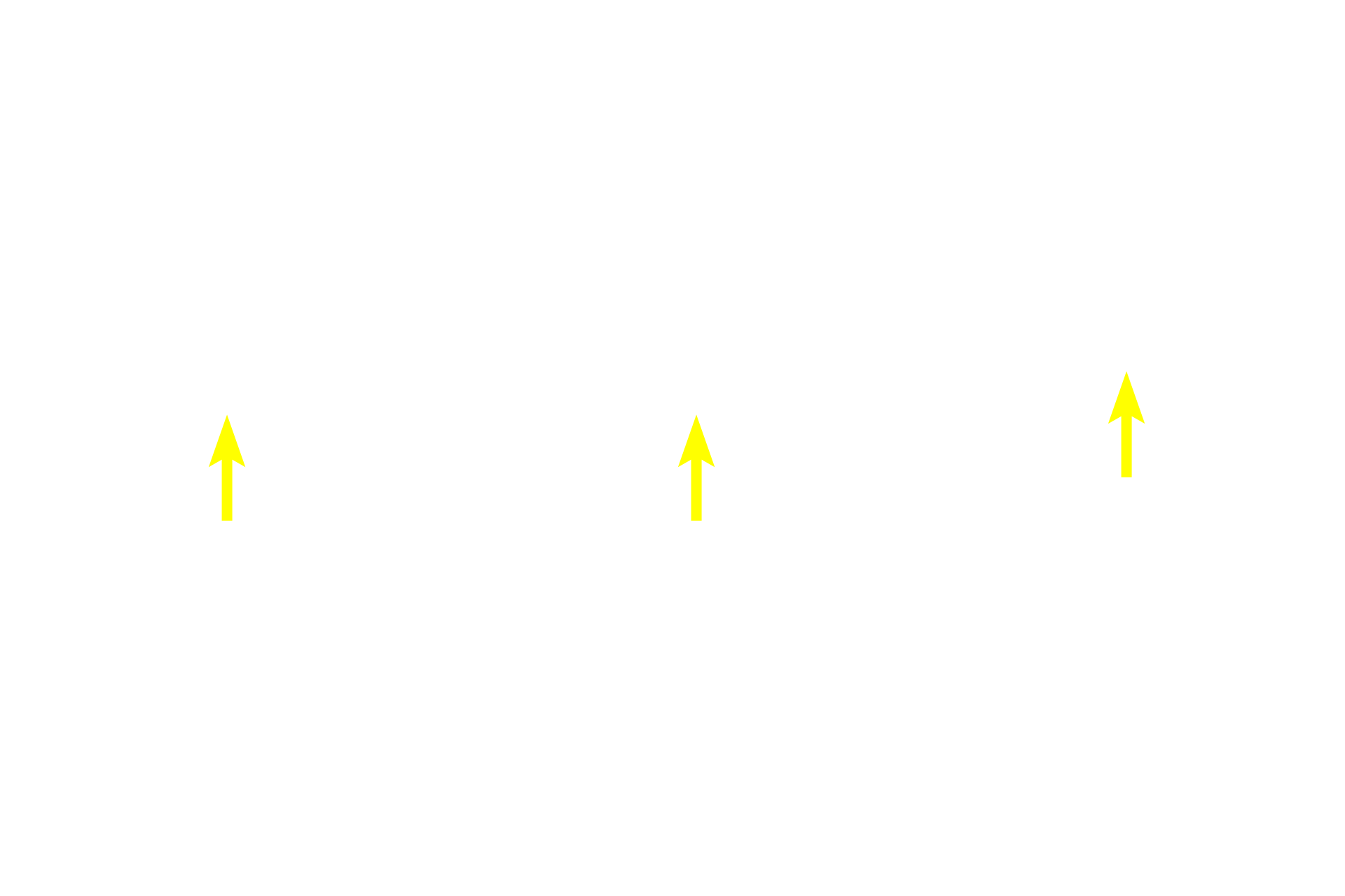 Sister chromatids <p>These three panels show cells in metaphase from the lining epithelium of the esophagus.  Paired sister chromatids are tightly aligned in the center of the cell forming the metaphase plate.  Though not visible in this image, spindle apparatuses composed of microtubules are present, as are two centrosomes at opposite ends of the spindle. Esophageal epithelium 1000x</p>
