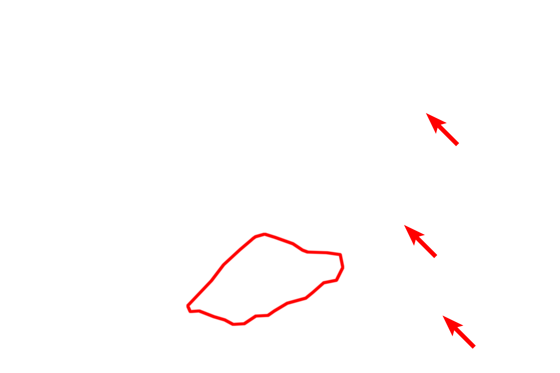 RER <p>This electron micrograph of a hepatocyte shows larger, more coarse accumulations of glycogen.  Liver  7500x</p>

