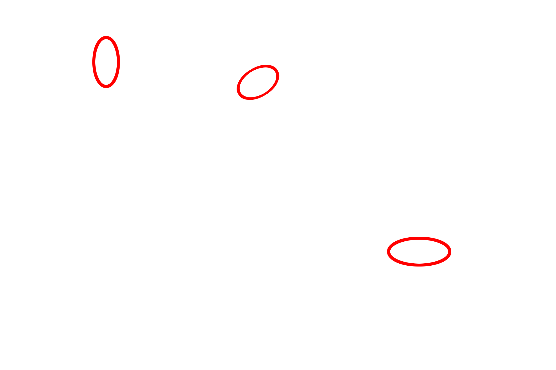 Coalescing droplets <p>This electron micrograph shows a cell whose cytoplasm contains numerous lipid droplets.  The lipid droplets are not surrounded by membranes, and often these droplets will coalesce into larger droplets.  The appearance of a membrane surrounding the droplet results from the presence of cytoskeletal elements at the periphery of the lipid.  6000x</p>
