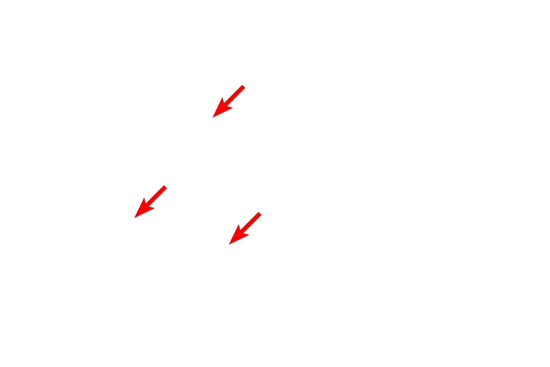  - Pars granulosa <p>This EM shows the subdivisions of the nucleolus.  The palest region, the fibrillar center, contains the nucleolar organizing regions of multiple chromosomes; the pars fibrosa (dense fibrillar component) contains the newly transcribed rRNA; and the pars granulosa contains maturing ribosomes.  This nucleolus is partially surrounded by perinucleolar heterochromatin.  35,000x</p>
