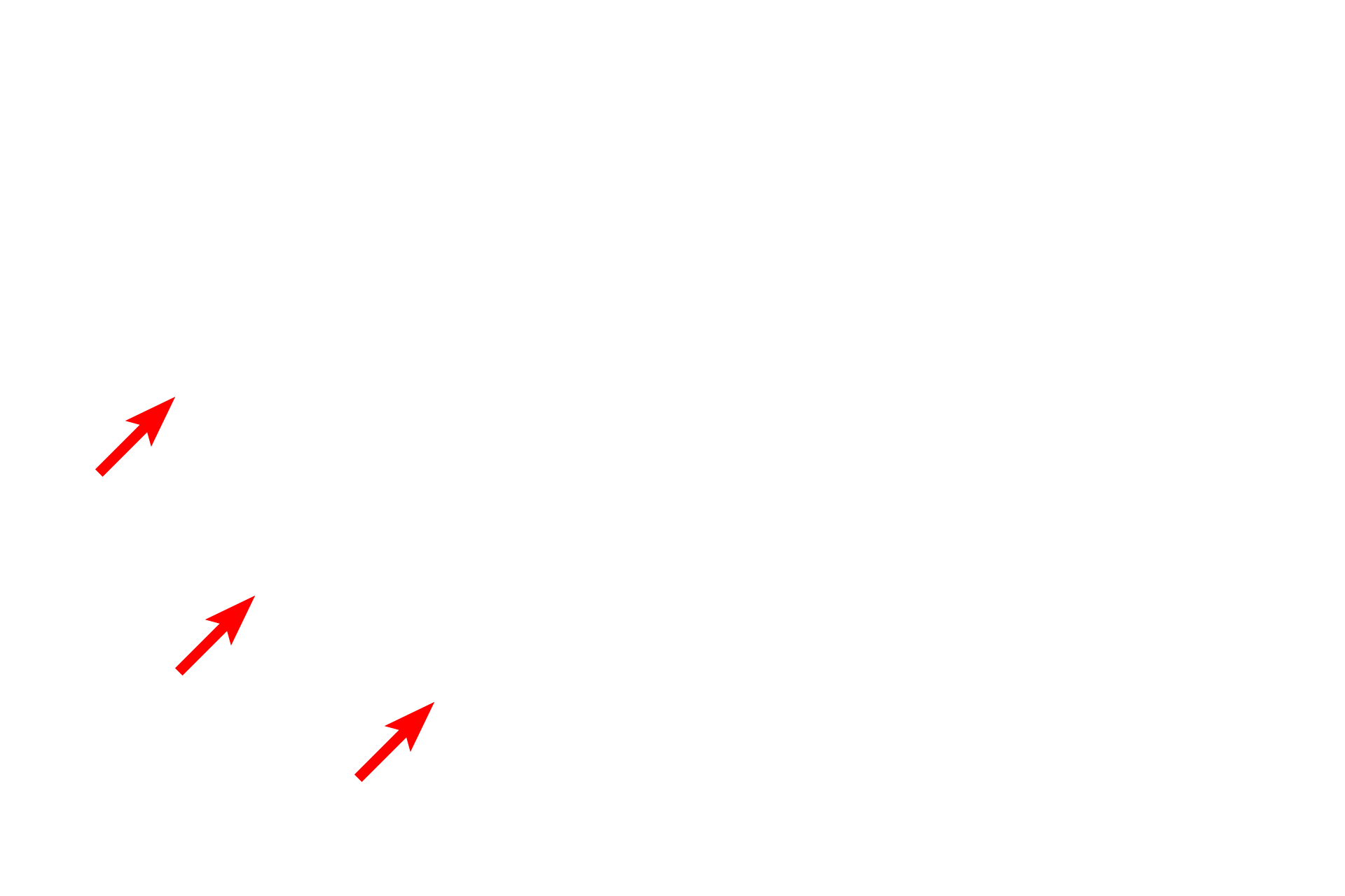 Perinucleolar heterochromatin <p>This EM shows the subdivisions of the nucleolus.  The palest region, the fibrillar center, contains the nucleolar organizing regions of multiple chromosomes; the pars fibrosa (dense fibrillar component) contains the newly transcribed rRNA; and the pars granulosa contains maturing ribosomes.  This nucleolus is partially surrounded by perinucleolar heterochromatin.  35,000x</p>
