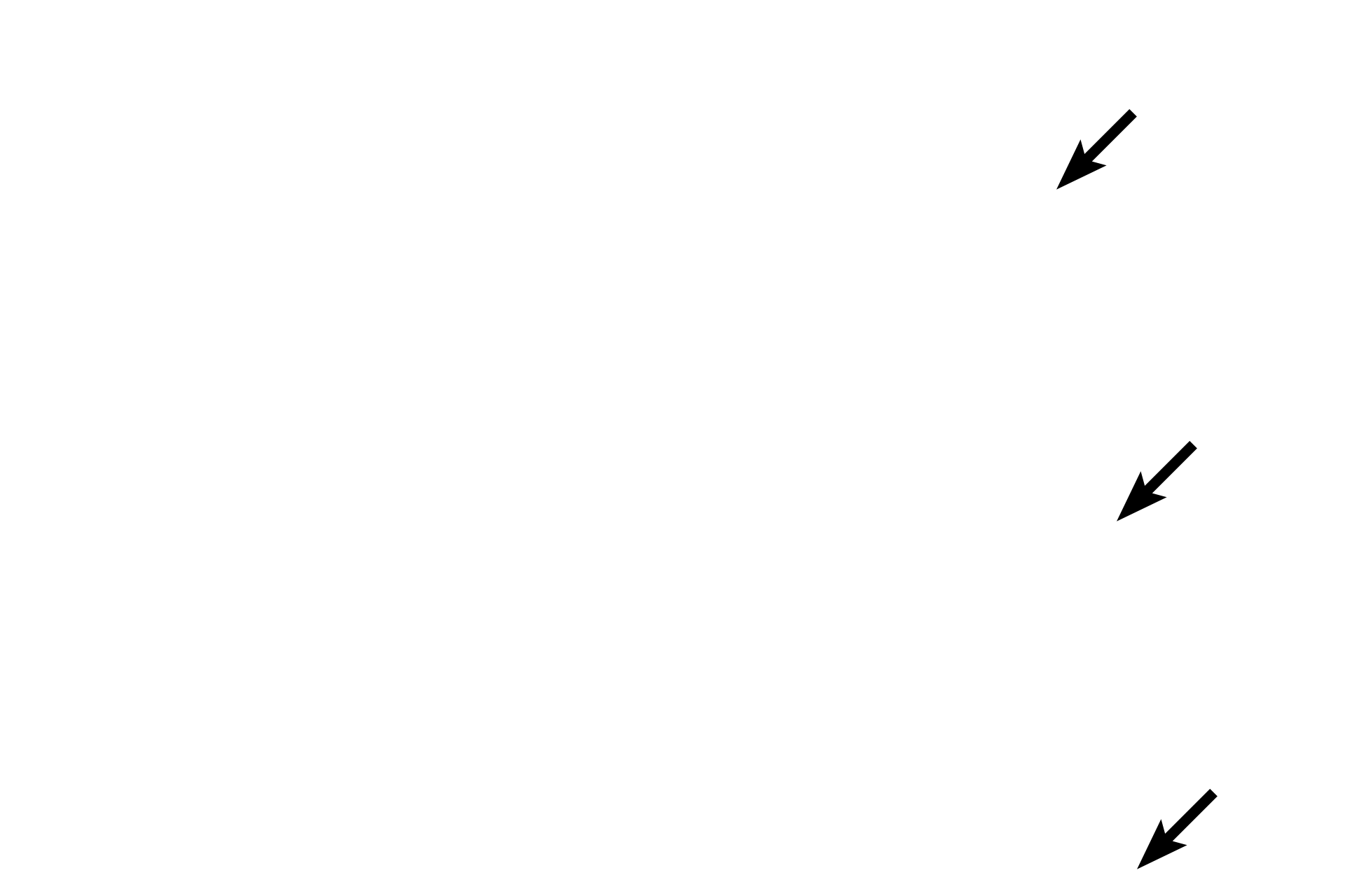 Dura mater <p>The dura mater is composed of dense irregular connective tissue.  The thin arachnoid membrane adheres to the dura and extends trabeculae across the subarachnoid space to the pia.  The pia mater lies directly on, and accompanies blood vessels into, the central nervous system.  The prominent subdural space and the displacement of the pia, seen here, are artifactual.  40x</p>
