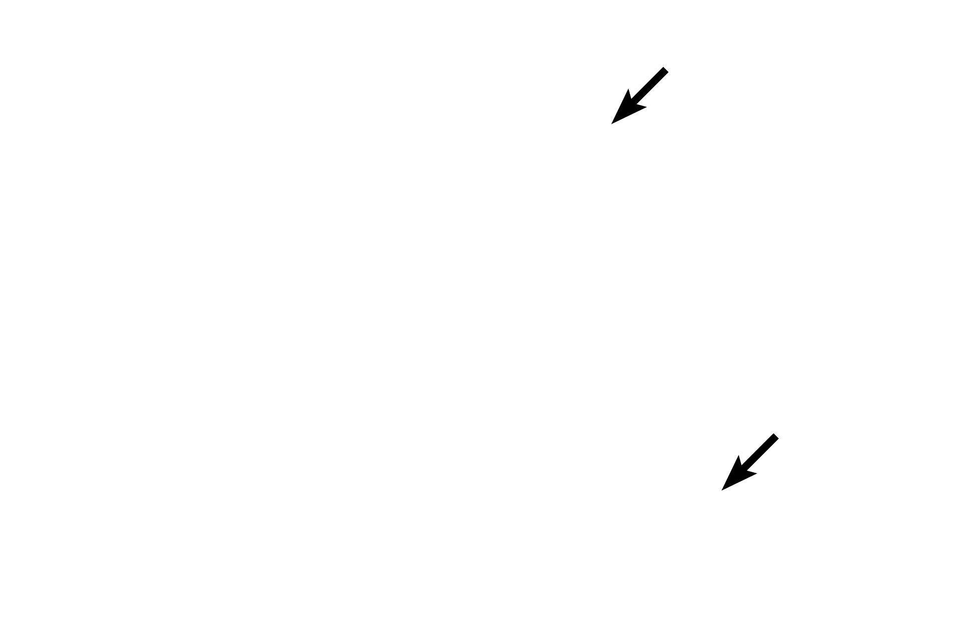 Subdural space <p>The dura mater is composed of dense irregular connective tissue.  The thin arachnoid membrane adheres to the dura and extends trabeculae across the subarachnoid space to the pia.  The pia mater lies directly on, and accompanies blood vessels into, the central nervous system.  The prominent subdural space and the displacement of the pia, seen here, are artifactual.  40x</p>
