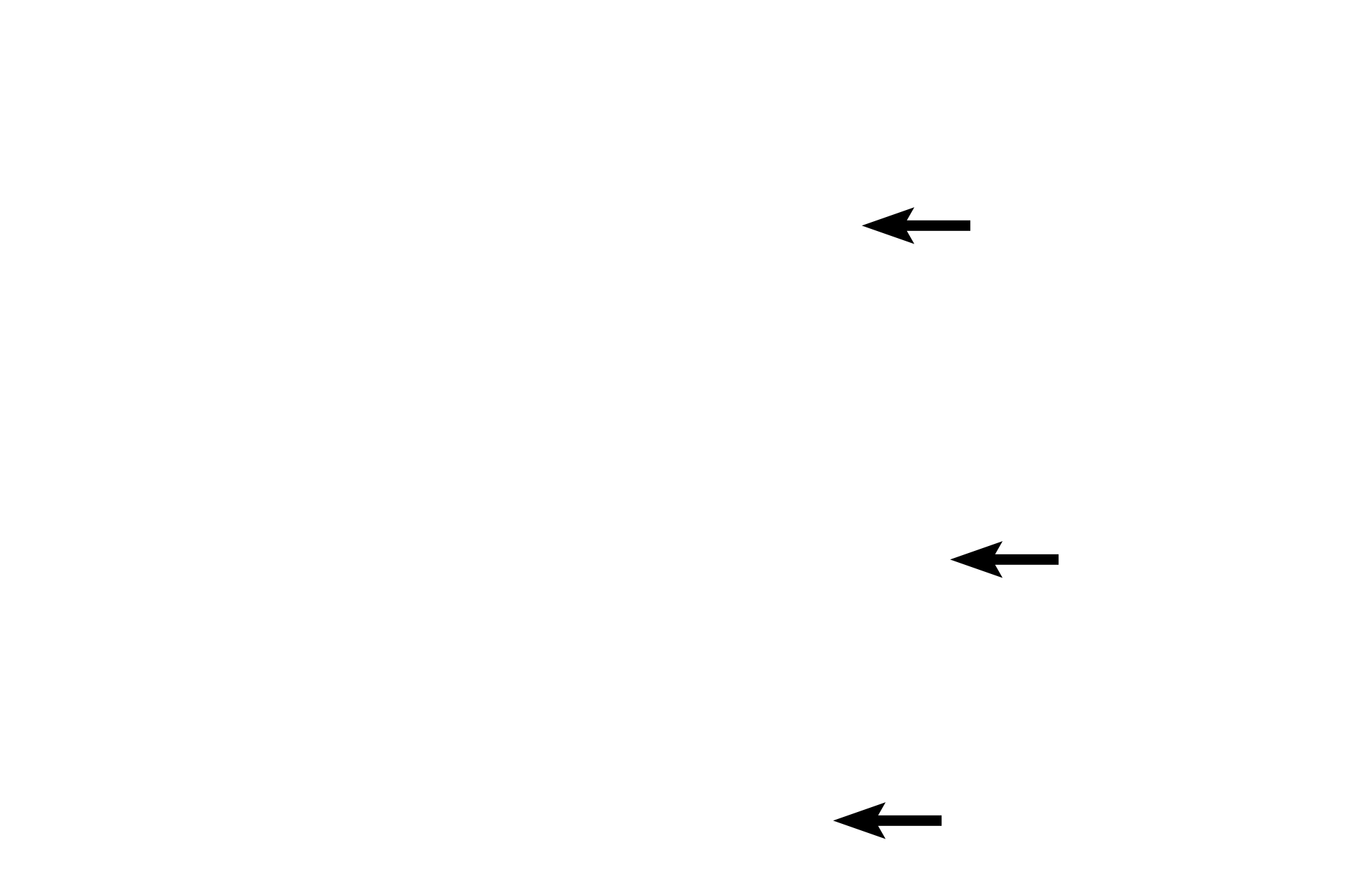 Arachnoid membrane <p>The dura mater is composed of dense irregular connective tissue.  The thin arachnoid membrane adheres to the dura and extends trabeculae across the subarachnoid space to the pia.  The pia mater lies directly on, and accompanies blood vessels into, the central nervous system.  The prominent subdural space and the displacement of the pia, seen here, are artifactual.  40x</p>
