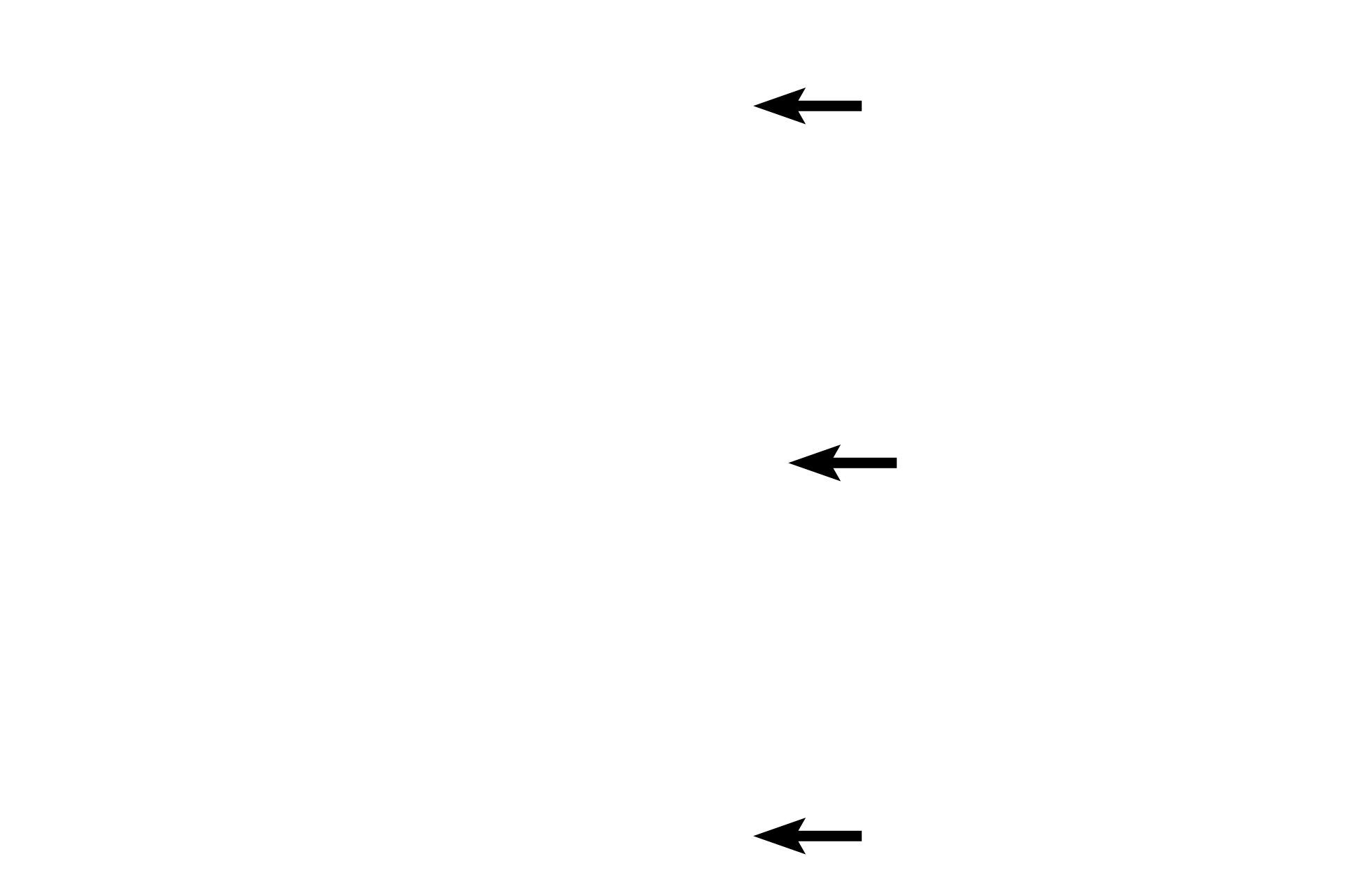 Subarachnoid space <p>The dura mater is composed of dense irregular connective tissue.  The thin arachnoid membrane adheres to the dura and extends trabeculae across the subarachnoid space to the pia.  The pia mater lies directly on, and accompanies blood vessels into, the central nervous system.  The prominent subdural space and the displacement of the pia, seen here, are artifactual.  40x</p>
