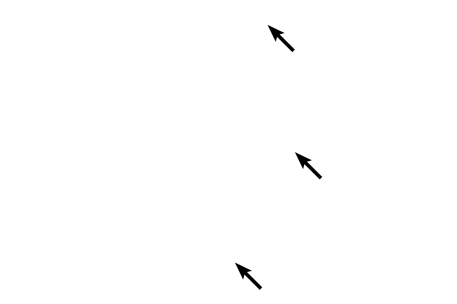 Remnants of trabeculae <p>The dura mater is composed of dense irregular connective tissue.  The thin arachnoid membrane adheres to the dura and extends trabeculae across the subarachnoid space to the pia.  The pia mater lies directly on, and accompanies blood vessels into, the central nervous system.  The prominent subdural space and the displacement of the pia, seen here, are artifactual.  40x</p>
