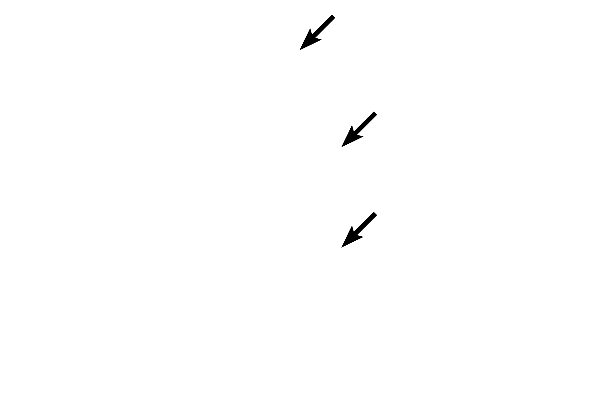 Blood vessels <p>The dura mater is composed of dense irregular connective tissue.  The thin arachnoid membrane adheres to the dura and extends trabeculae across the subarachnoid space to the pia.  The pia mater lies directly on, and accompanies blood vessels into, the central nervous system.  The prominent subdural space and the displacement of the pia, seen here, are artifactual.  40x</p>
