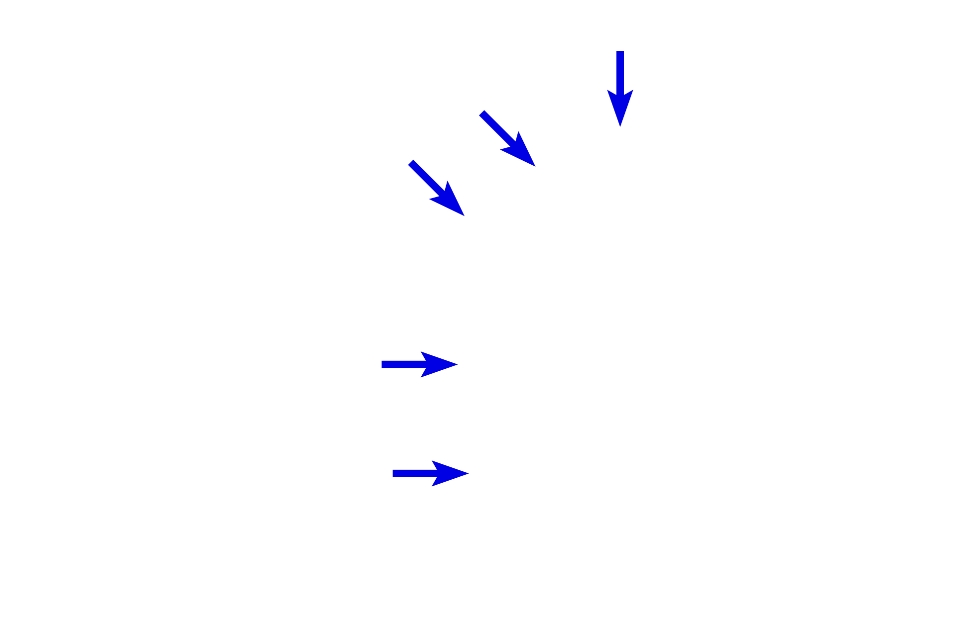 Epineurium > <p>The epineurium consists of a dense irregular connective tissue of collagen bundles that blends with the surrounding connective tissue. Epineurium surrounds larger trunks of peripheral nerves and is lost as peripheral nerves decrease in size.</p>
