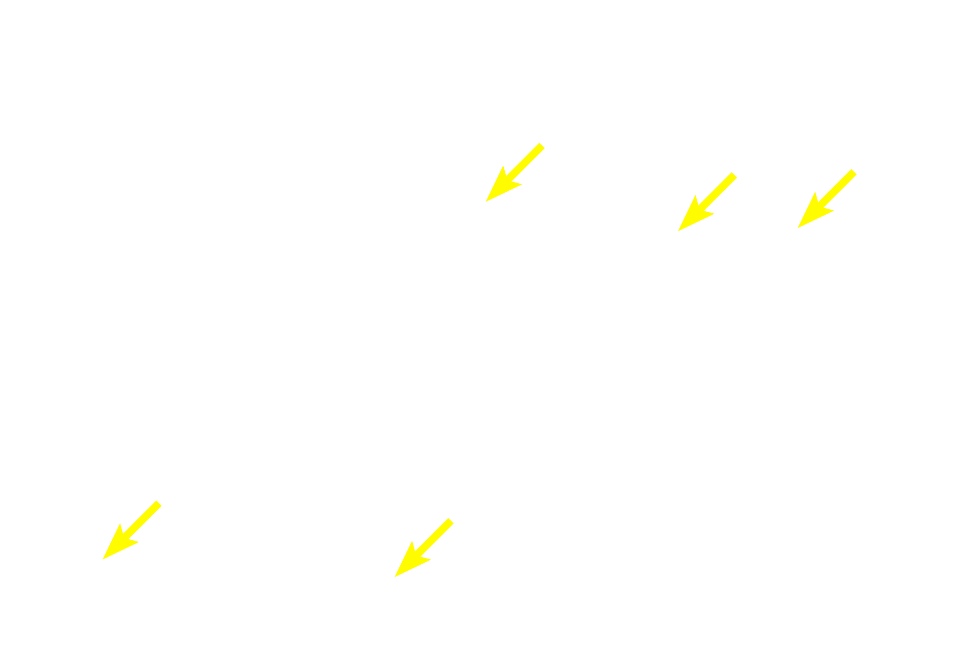 Myelinated axons <p>At higher magnification the histological distinctions between the perineurium and epineurium are seen.  The perineurium is more basophilic, highly cellular and very compact.  In contrast, the epineurium is more eosinophilic, contains collagen fibers and fewer cells.  Note myelinated axons of various sizes and Schwann cell nuclei.  400x</p>
