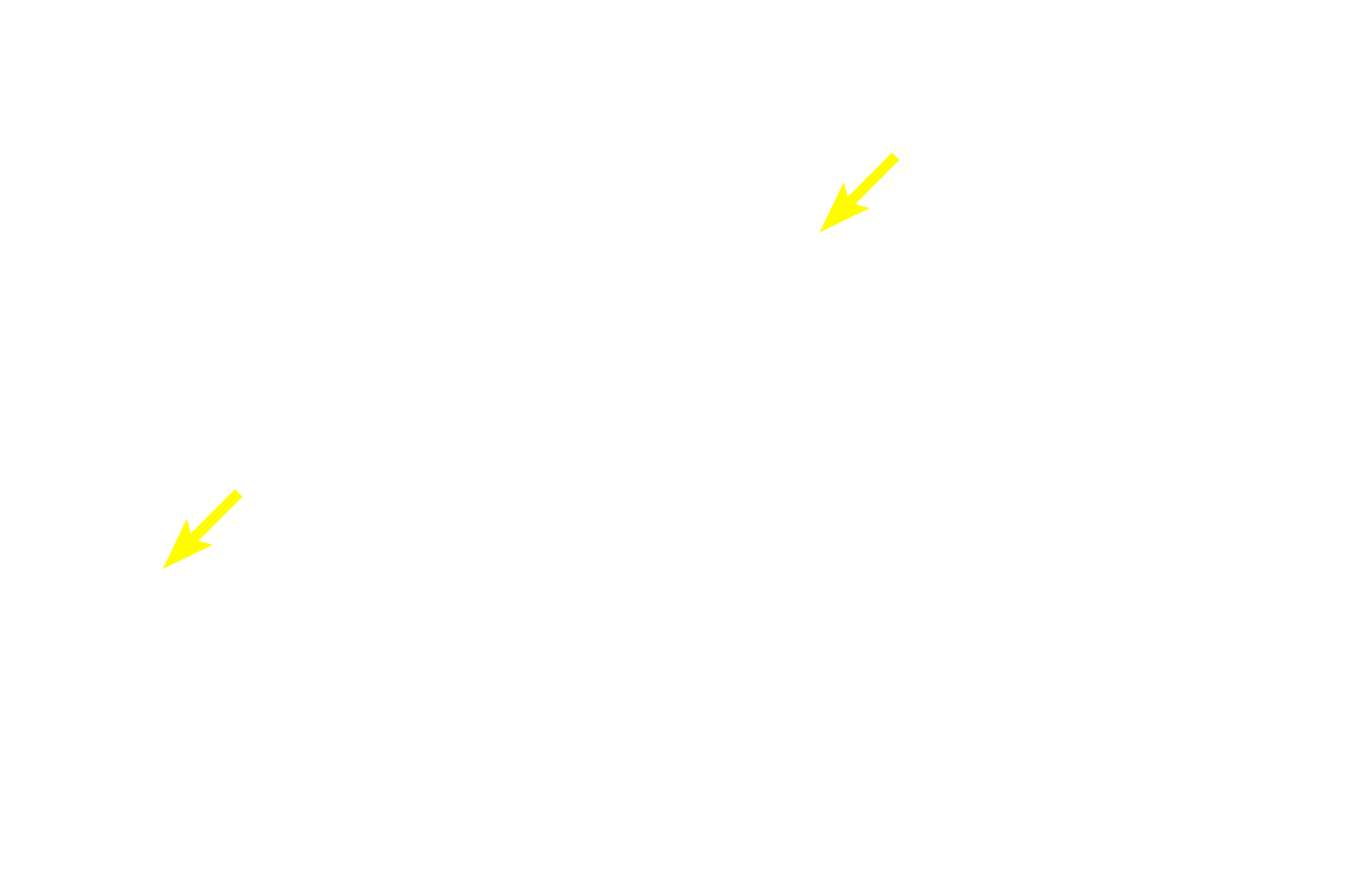 Schwann cell nuclei <p>A longitudinal section of a nerve fascicle, shows several myelinated axons.  Two nodes of Ranvier are  visible between adjacent internodes of the myelin sheath.  The axon can be seen passing through the nodal region; Schwann cell nuclei are visible between vacuolated-appearing myelin sheaths.  1000x</p>
