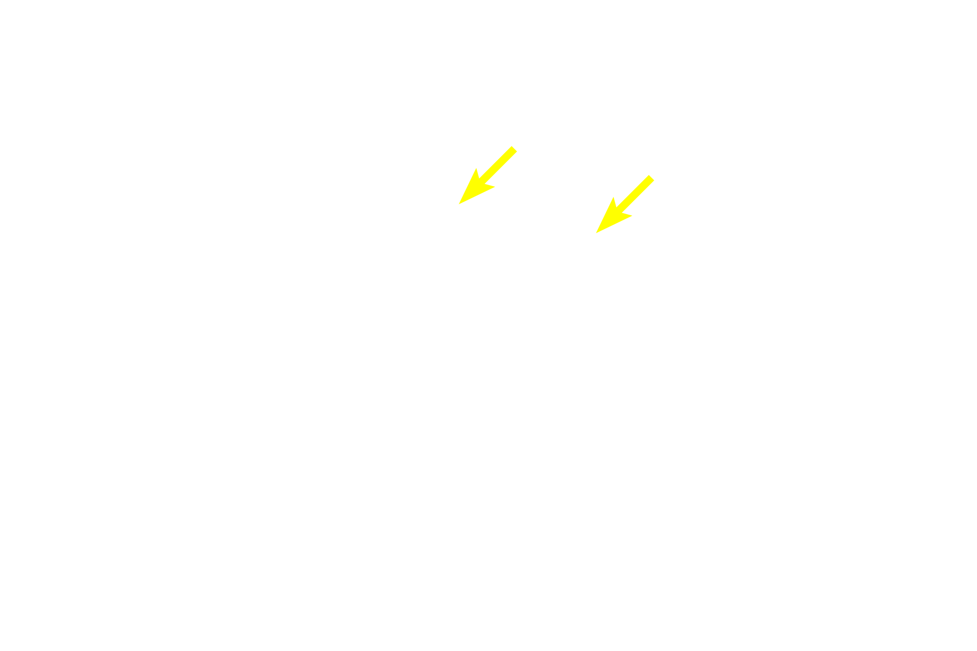  - Interlobular ducts <p>A compound, tubuloacinar gland consists of both tubular and acinar secretory units and the gland is subdivided by connective tissue into lobules   Draining the secretory units are intralobular ducts, which are contained entirely within the lobule.  Interlobular ducts are located in the interlobular connective tissue and drain multiple lobules.  This gland is the submandibular (submaxillary) gland which is one of the major salivary glands.  Submandibular gland  40x</p>
