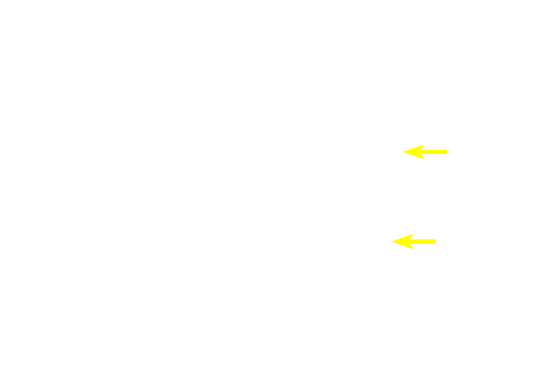  -- Stratified columnar epithelium <p>The secretory units in this gland consist of spherical acini and elongated tubules.  Their secretions are immediately drained by intralobular ducts which flow into larger interlobular ducts located in the interlobular connective tissue between lobules.  Interlobular ducts are often lined by a stratified columnar epithelium.  Submandibular gland 400x</p>
