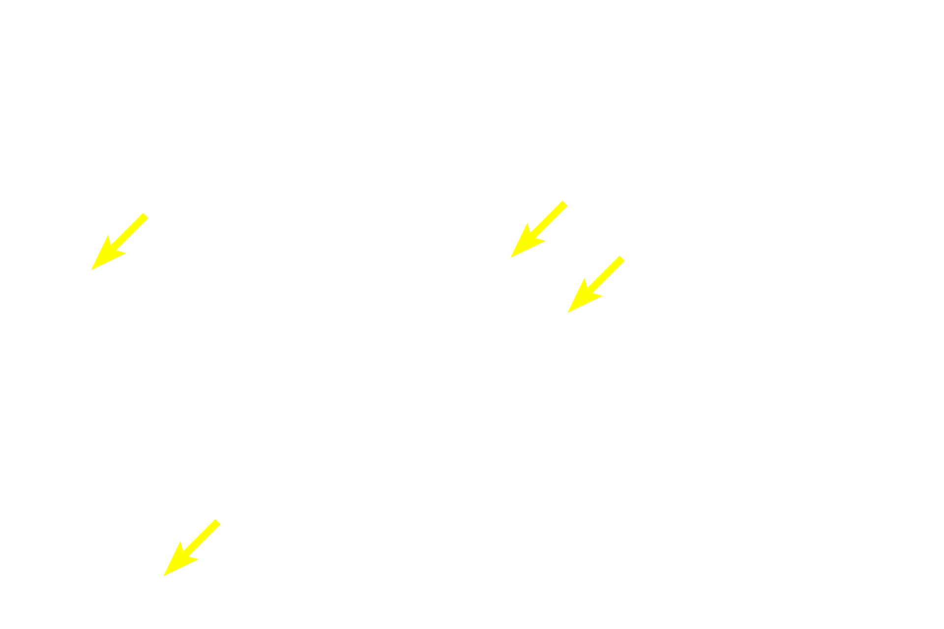 - Mucous tubule lumens <p>Mucus-secreting cells are easily distinguished from those releasing a serous product. Mucous cells are frothy in appearance and are arranged as tubules with wide lumens.  Serous-secreting cells can be arranged as acini or as serous demilunes. Each acinus has a small lumen surrounded by wedge-shaped cells with secretory granules.  Serous demilunes possess similar cells, but they are configured as crescent-shaped units capping the ends of tubules.  Submandibular  1000x</p>
