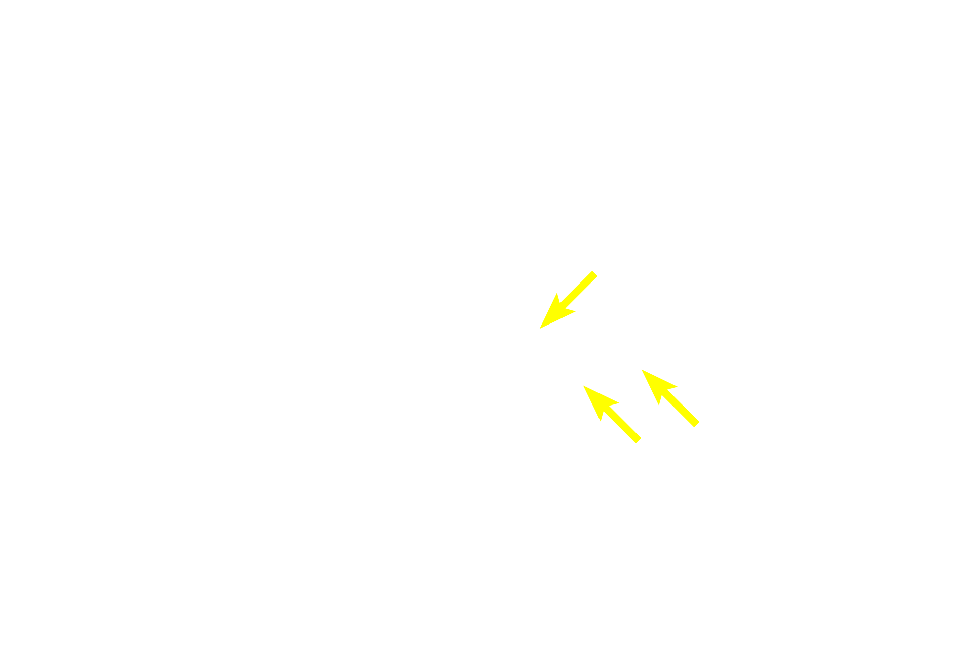 Acini opening into duct <p>In addition to a tubular configuration, the secretory units of a simple gland can also be acinar.  This example shows a gland with an unbranched duct into which the acini (alveoli) release their secretory product.  This is a Meibomian gland (tarsal gland) and is located in the eyelid.  It secretes an oily material by the holocrine mode of secretion that covers the watery tear film layer on the surface of the eye to prevent drying.  Eyelid 100x</p>
