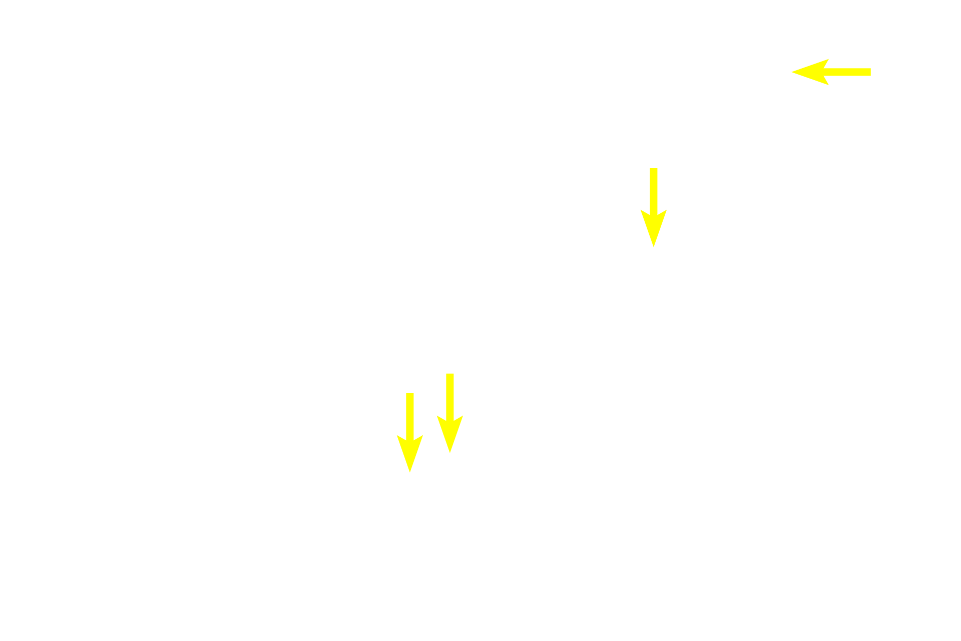  - Wide lumen with secretory product <p>Shown here is another example of an apocrine sweat gland, which contrary to their name, secrete by the merocrine mode of secretion.  The secretory product is thick and protein-rich, hence the lumen is much wider than that seen in eccrine sweat glands.  The secretions acquire a distinctive odor by the action of bacteria on the surface of the skin.  The ducts of these glands open into hair follicles near those of the sebaceous glands.  Apocrine sweat glands are located in the anal and axillary regions as well as in the nipple of the breast. Anus 400x</p>
