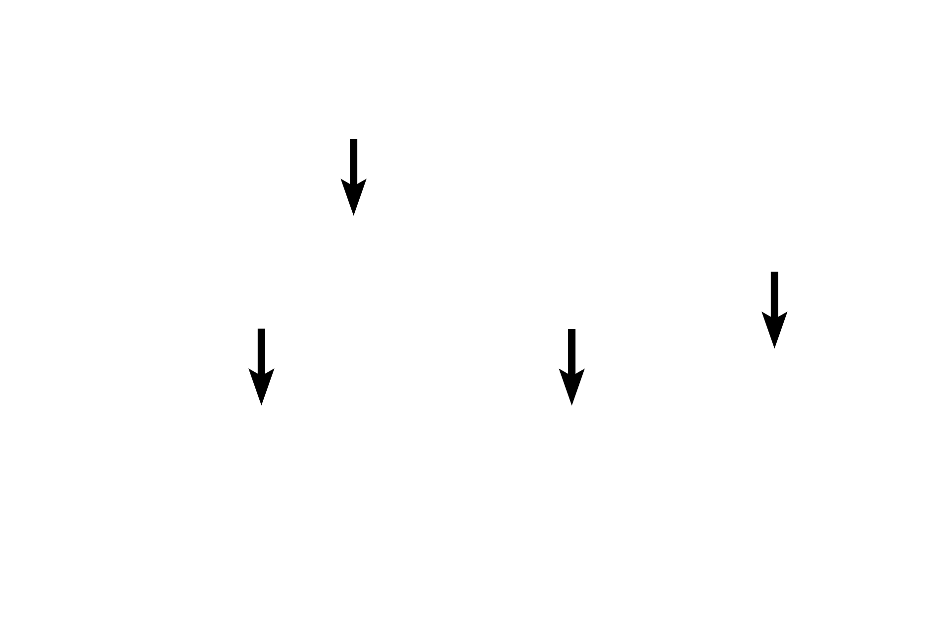 Cytoplasmic lipid droplets <p>These secretory cells of the mammary glands in the breast secrete by both the merocrine mode, for the protein component of milk, and the apocrine mode for the lipid components.  Apocrine secretion involves the loss of a small amount of surface plasma membrane and cytoplasm along with the secretory product.  Note the secretory product being released in the lower right of the image.  Apocrine secretion occurs only in mammary glands.  Breast 1000x</p>
