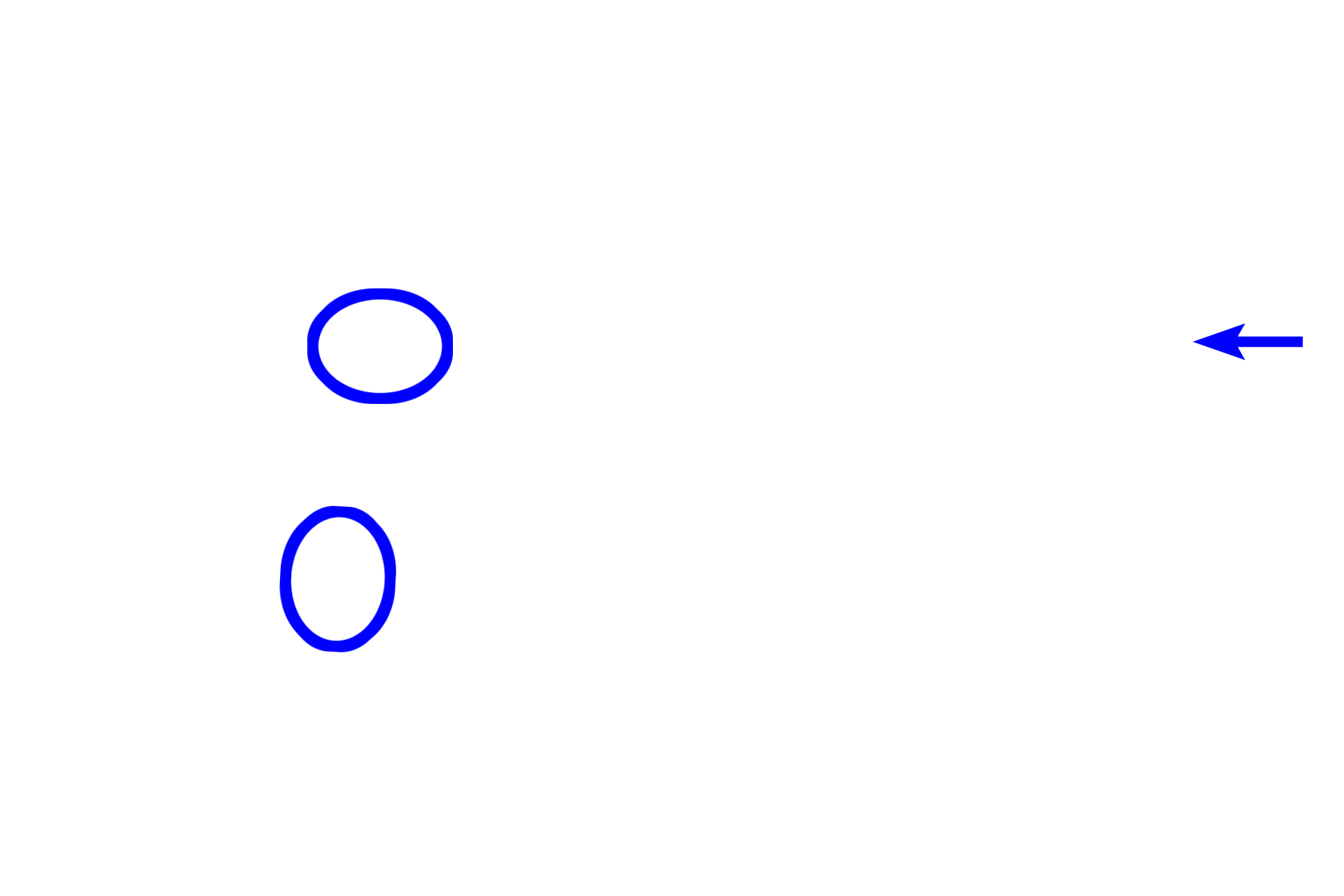  - Desmosomes <p>Junctional complexes are found at the apex of epithelial cells and have three components:  Zonula occludens, a band or belt encircling each cell that seals the lumen from the intercellular space; Zonula adherens, also a band that attaches adjacent cells to each other; and Desmosomes (maculae adherentes), which also provide cell attachment but consists of disk-like structures rather than encircling belts.  Desmosomes are also distributed in other regions of the cell.</p>
