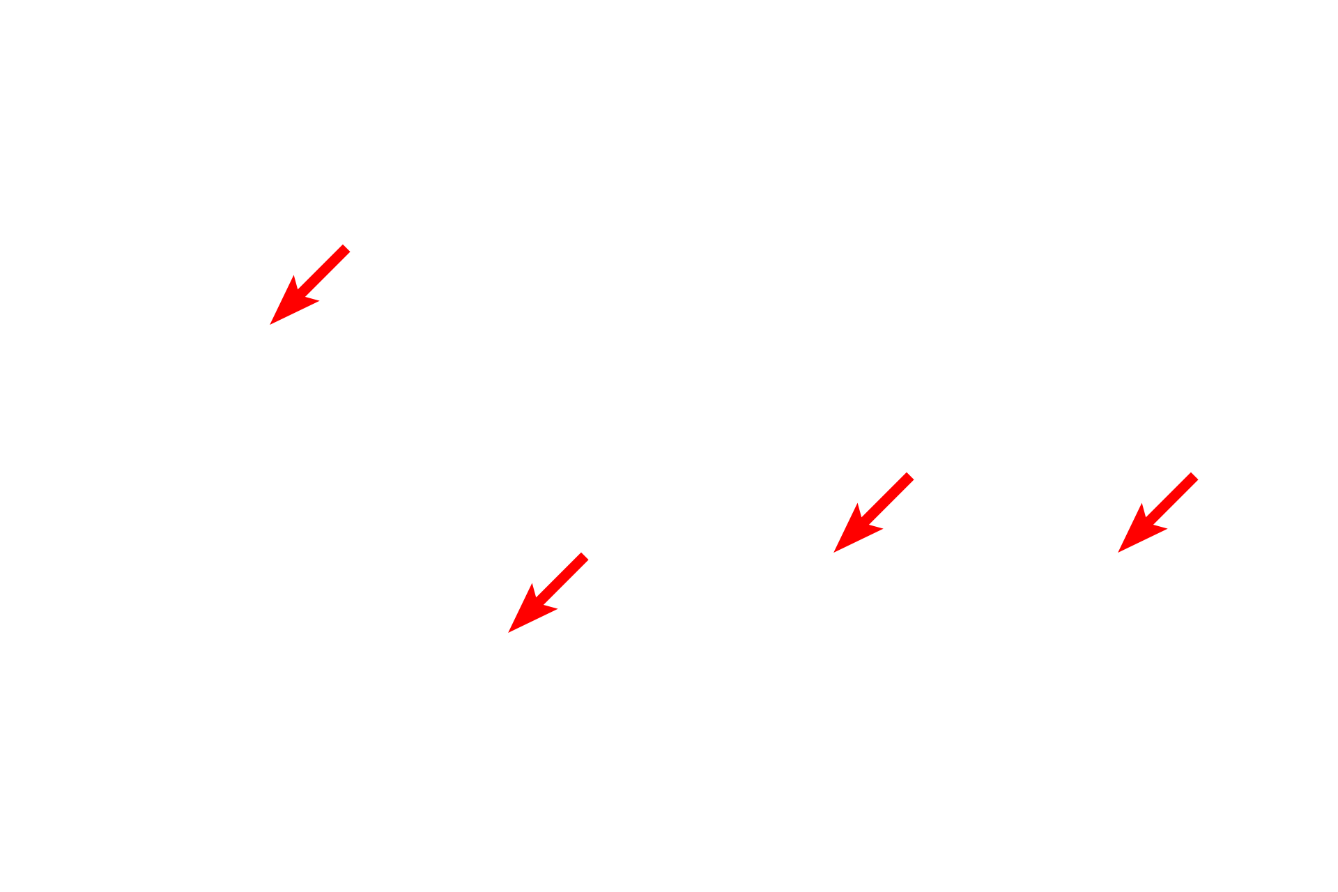 Lamina lucida <p>This electron micrograph of human skin shows the details of the basement membrane of an epithelium that is exposed to significant physical force. Numerous hemidesmosomes, which anchor the basal surface of the epithelial cells to the basal lamina, are present. Associated keratin filaments insert into the attachment plaques of the hemidesmosomes. Also visible are prominent anchoring fibrils that secure the epithelium to the underlying connective tissue. 45,000x</p>
