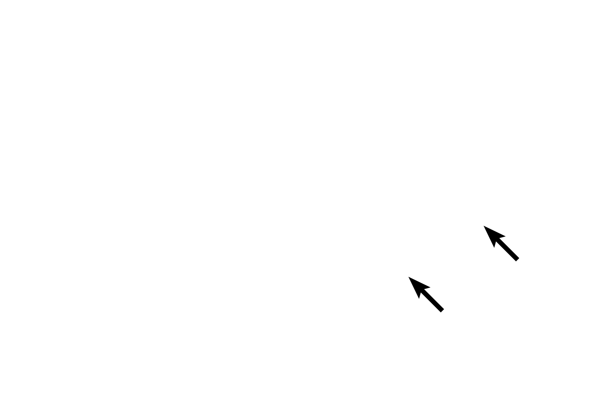 Attachment of chordae tendineae <p>The leaflets of atrioventricular valves are folds of endocardium covered with endothelium on their free surfaces.  The core of each leaflet consists of dense irregular connective tissue that is continuous with the annulus fibrosis. Also seen is the attachment point for one of the chordae tendineae, fibrous cords which extend from the valve leaflet to one of the papillary muscles.   400x</p>
