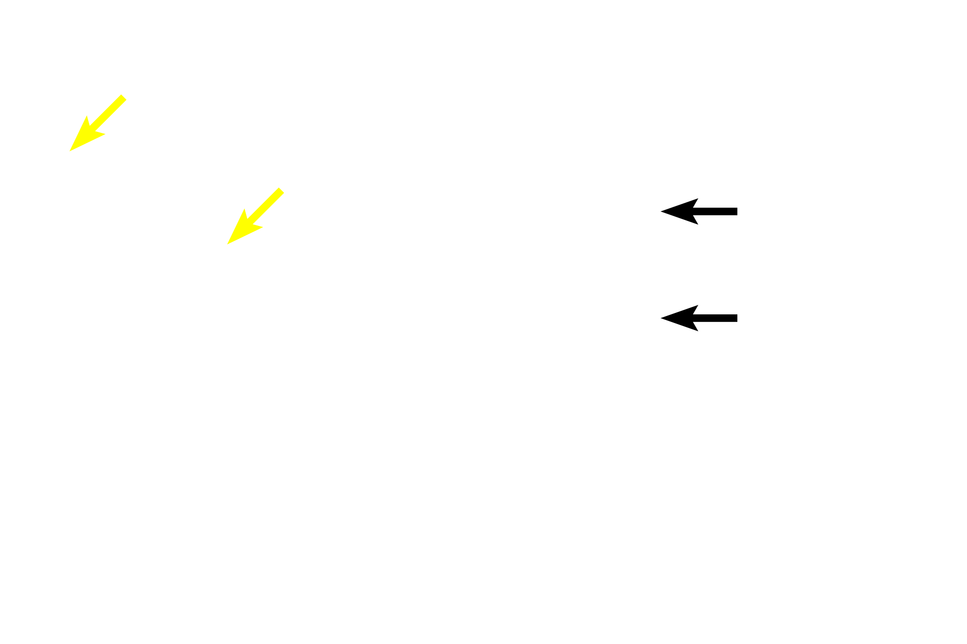 Tunica adventitia <p>This image shows a small artery and vein coursing through connective tissue, along with a peripheral nerve. Arteries and veins of similar caliber often travel together in such a neurovascular bundle. These smaller vessels retain the same structural characteristics as larger ones. The small artery has a thick, distinct, muscular tunica media and a narrow lumen, while the vein consists primarily of a tunica adventitia and has a larger lumen. 100x</p>
