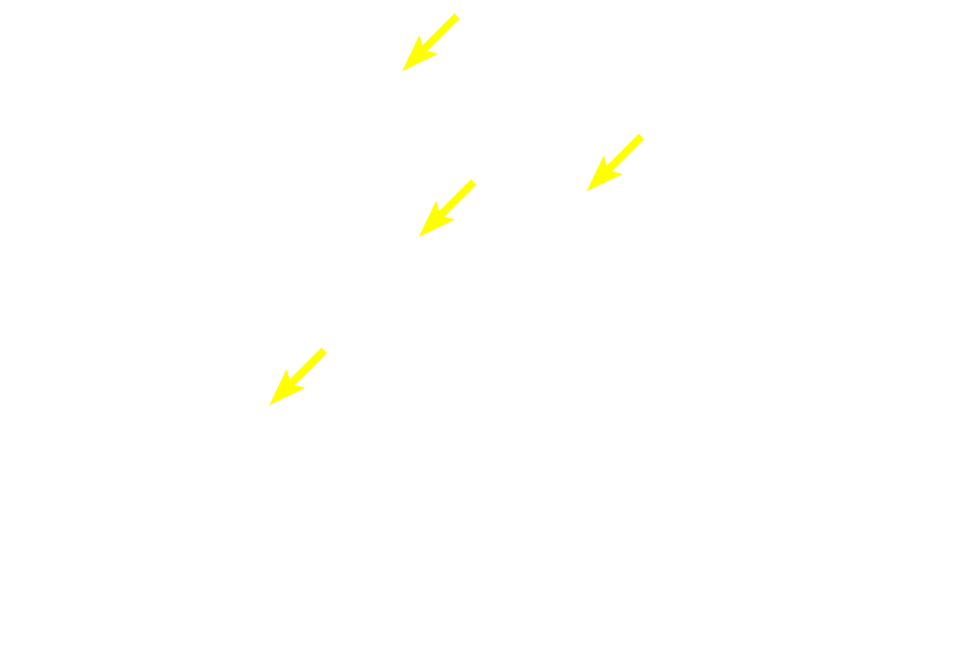 Oxyphil cells <p>Chief, or principal, cells are small, polygonal cells with centrally located nuclei.  Oxyphil cells can be clearly distinguished from the principal cells by their larger size and abundant, eosinophilic cytoplasm.  Note the large number of capillaries between the rows of chief and oxyphil cells.  1000x</p>
