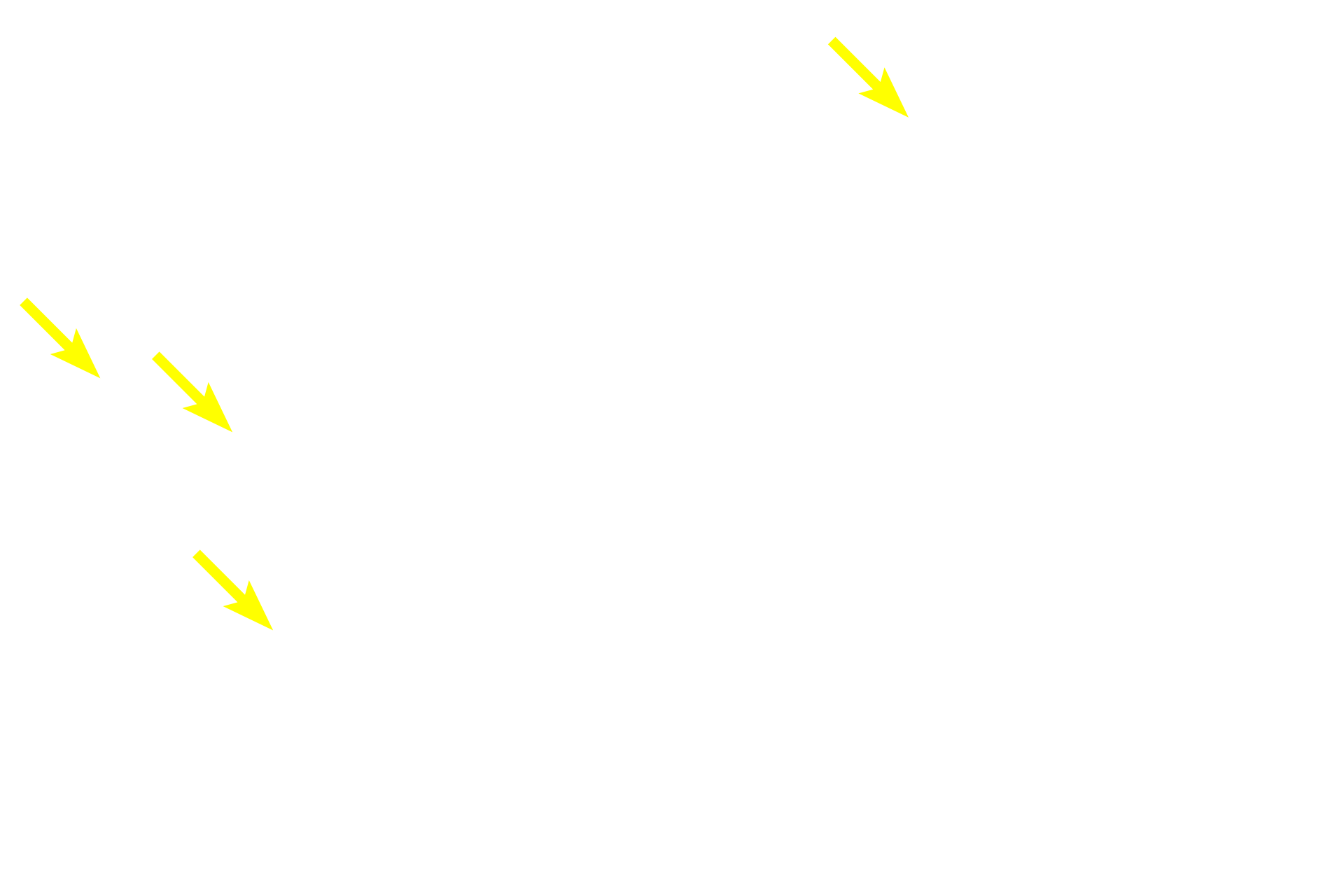 Acidophils <p>With this Masson stain, acidophils stain orange, basophils stain greenish-purple and the connective tissue stroma stains green.  Basophils are generally larger than acidophils.  Basophils can be further subdivided into thyrotropes, gonadotropes and adrenocorticotropes.  Acidophils are subdivided into mammotropes and somatotropes.  1000x</p>
