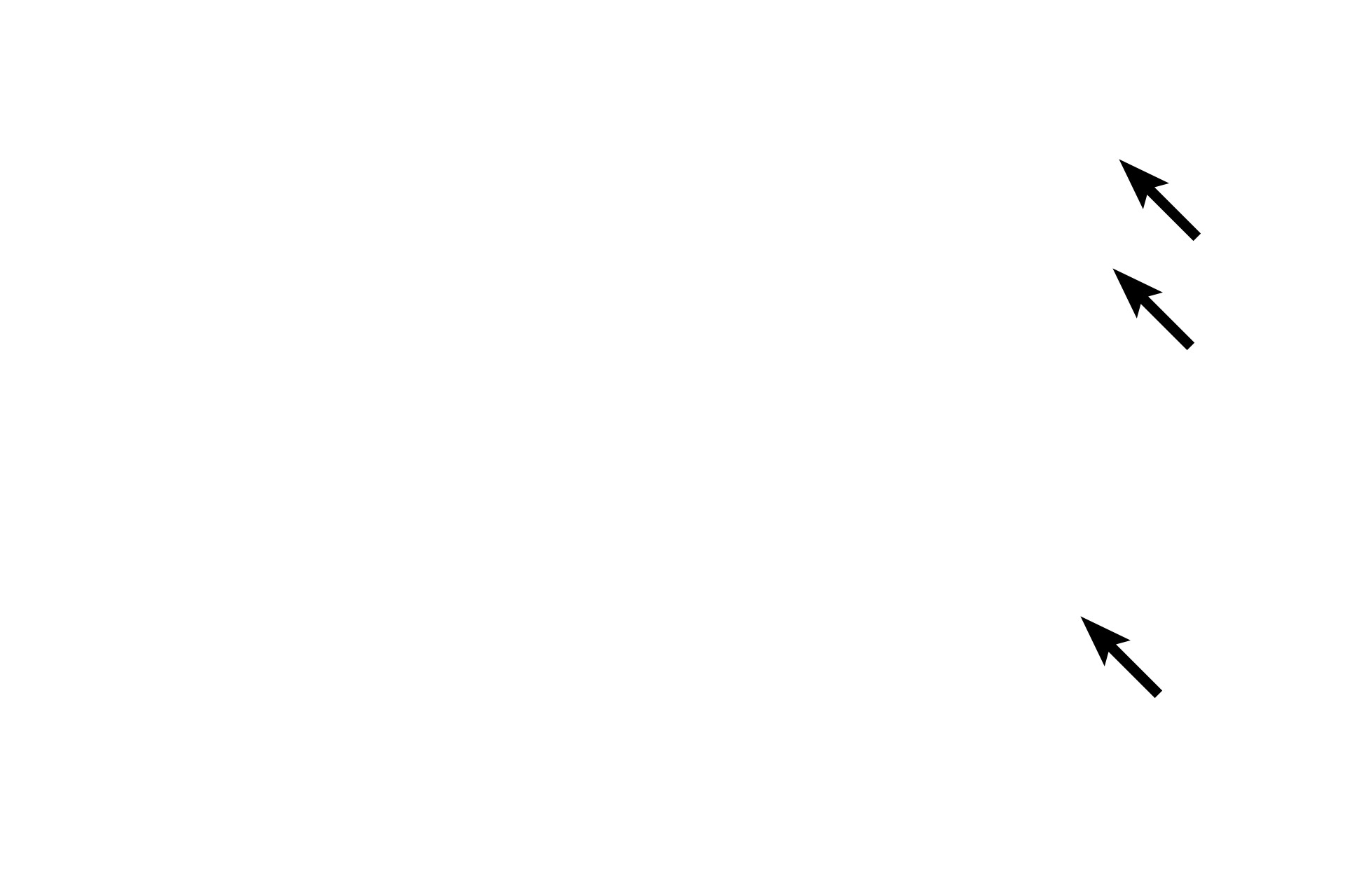 Granules <p>The increased height of the follicle cells results from a greater abundance of synthetic and protein-processing organelles.  Also present are granules, which are involved either in the transport and release of thyroglobulin into the lumen or resorption and processing of thyroglobulin to release T3 and T4 into the surrounding capillaries.</p>
