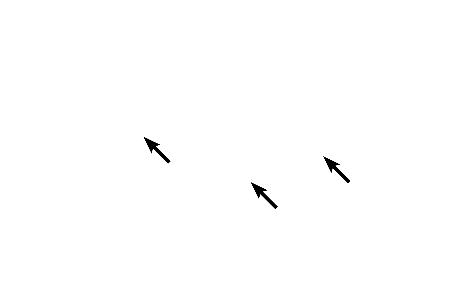  - Secretory granules <p>Parafollicular cells or C cells are located both in the interfollicular connective tissue and within the basal lamina of the follicular epithelium (seen here). These cells are separated from the thyroglobulin by processes from adjacent follicle cells extending over the parafollicular cells.  Parafollicular cells have a pale cytoplasm with secretory granules containing calcitonin.  Calcitonin secretion lowers, and is regulated by, blood calcium levels.  1000x</p>
