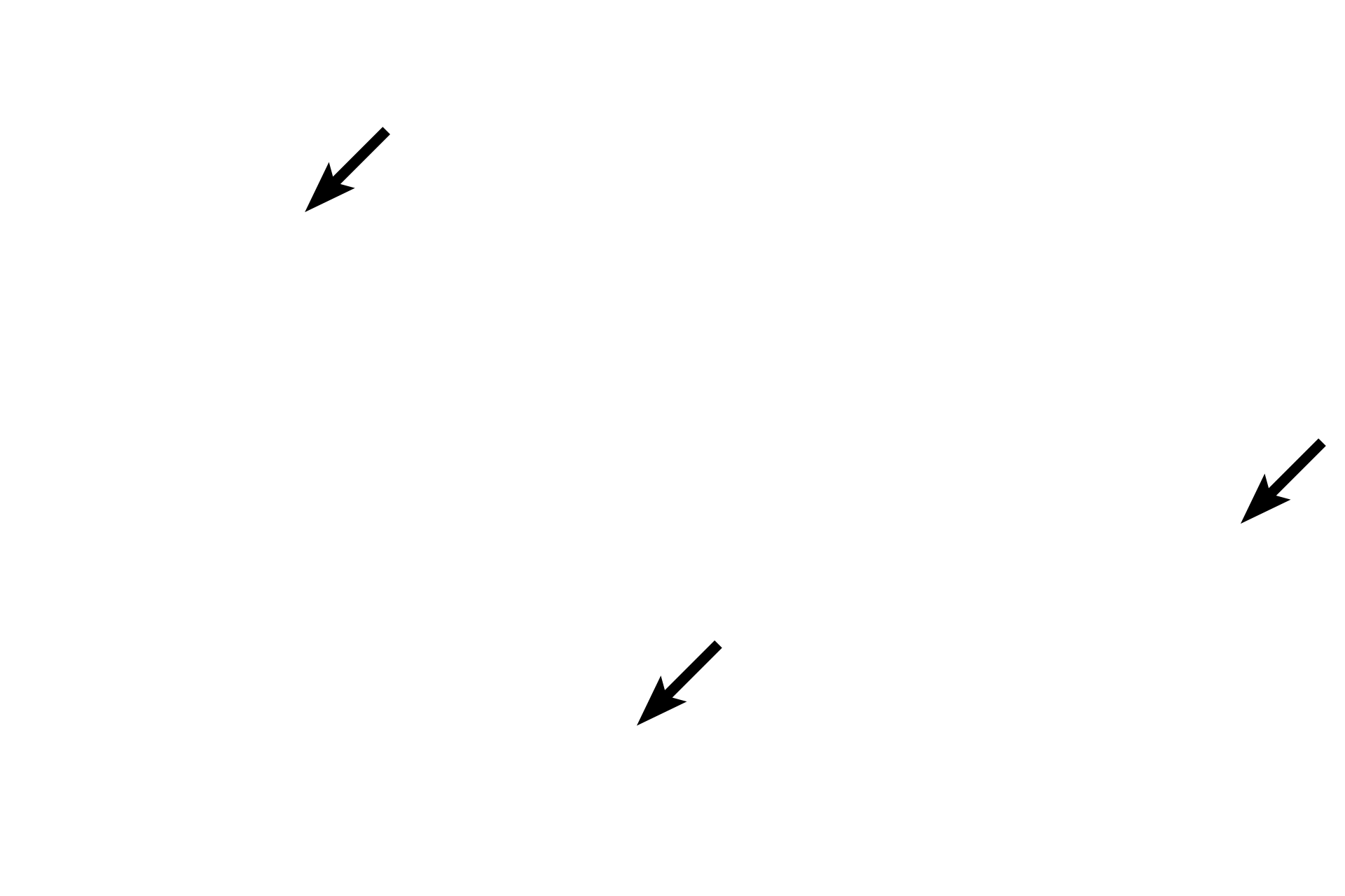 Red blood cells <p>Eosinophils are granular leucocytes with heterochromatic, bilobed nuclei and bright eosinophilic granules that fill the cytoplasm. Like neutrophils, eosinophils function in tissues and readily exit the blood stream. Eosinophils play a role in allergic reactions and parasitic infections as well as phagocytosis. 1000x</p>
