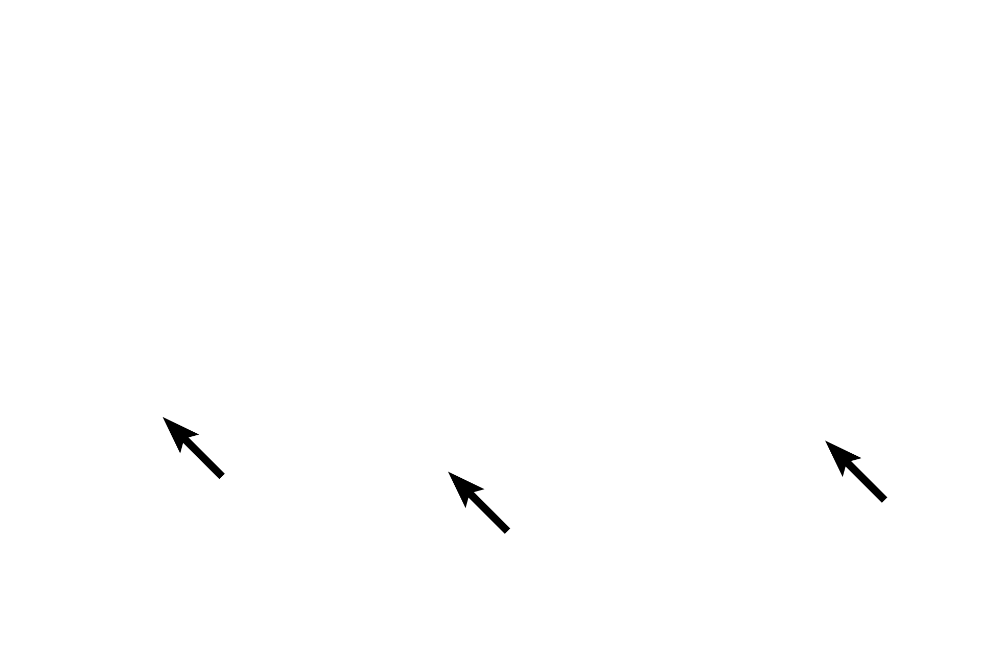 Platelets <p>Eosinophils are granular leucocytes with heterochromatic, bilobed nuclei and bright eosinophilic granules that fill the cytoplasm. Like neutrophils, eosinophils function in tissues and readily exit the blood stream. Eosinophils play a role in allergic reactions and parasitic infections as well as phagocytosis. 1000x</p>
