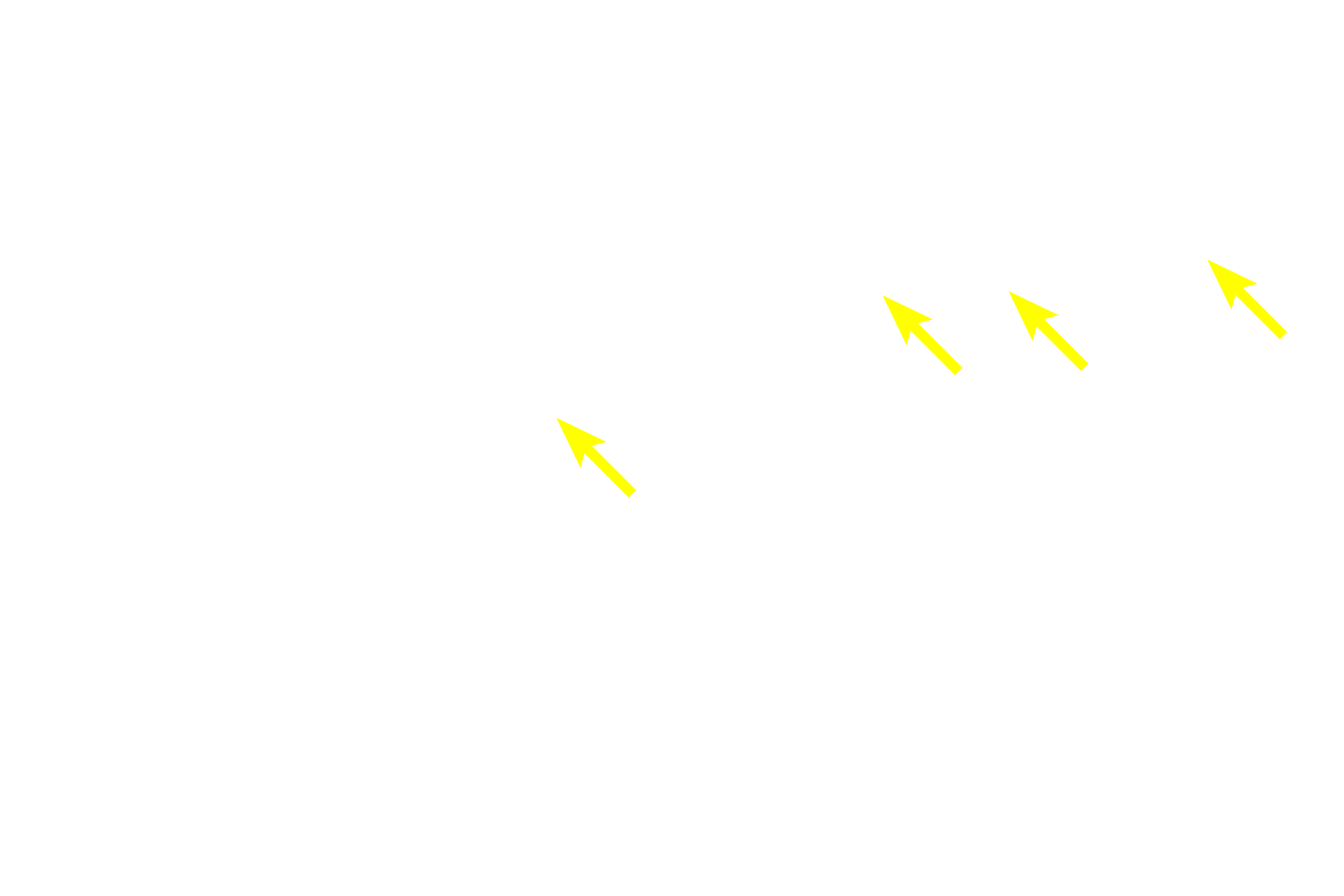  - Keratohyalin granules <p>The stratum granulosum is three to five cell layers thick and is composed of cells filled with prominent, basophilic, keratohyalin granules. The contents of these granules aggregate the tonofibrils into a matrix and initiate cornification of the plasma membrane.  Simultaneously, the organelles in these cells degenerate, resulting in cornified scales that form the stratum corneum.  200x, 1000x</p>
