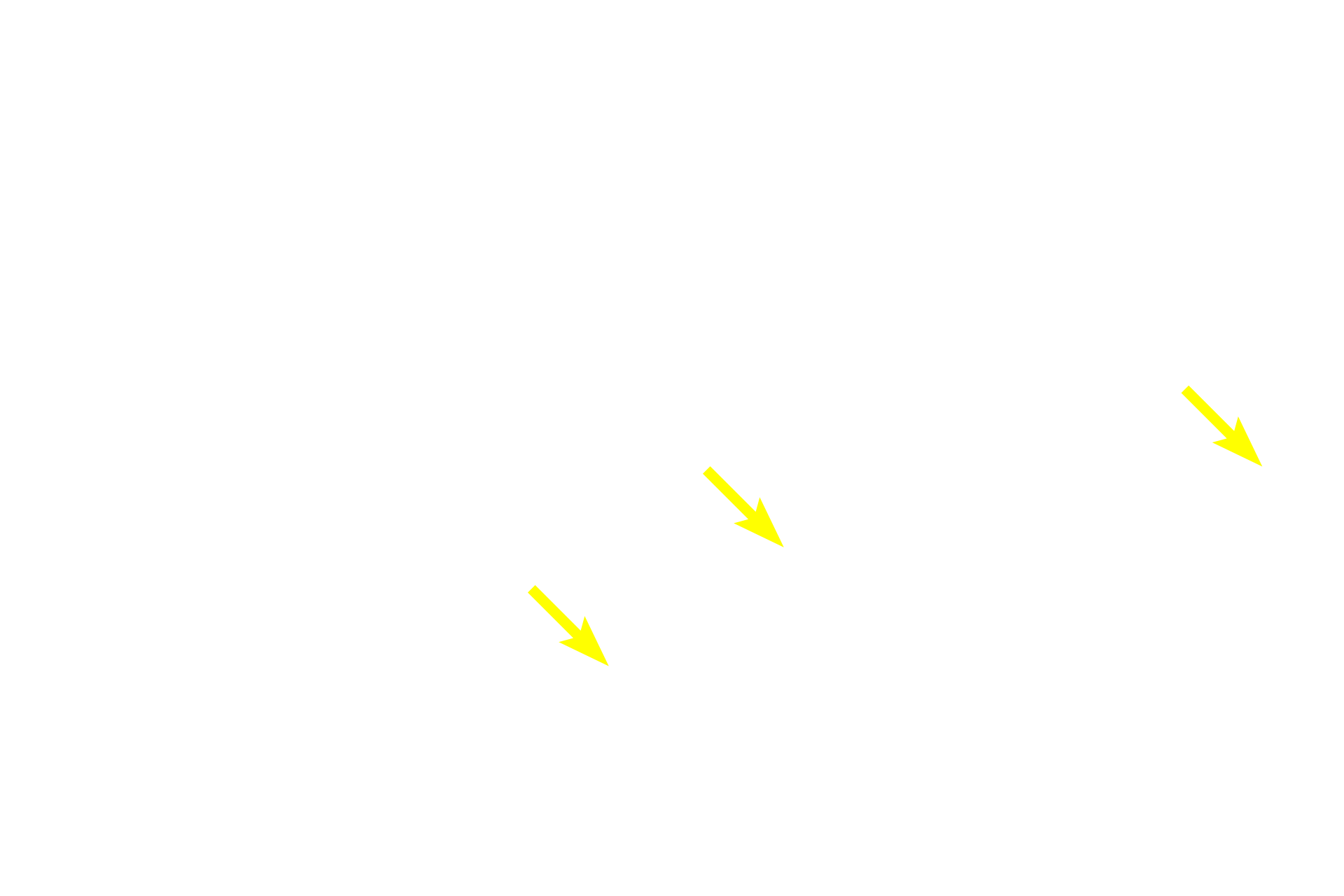  - Stratum lucidum <p>Thick skin, located on the fingertips, palms and soles of the feet, has a much thicker stratum corneum.  Additionally, a stratum lucidum is present between the stratum granulosum and the stratum corneum.  The stratum lucidem is a clear layer of non-nucleated, flattened cells, and is considered a subdivision of the stratum corneum. 100x</p>
