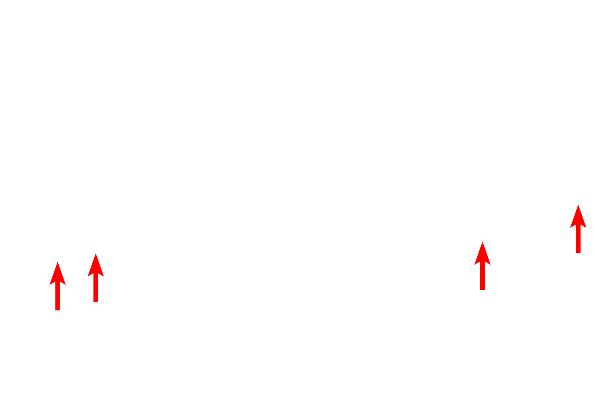 Melanocytes <p>This section shows a more highly pigmented epidermis with increased melanin in the stratum basale cells.  Melanocytes, identified by their clear cytoplasm and heterochromatic nuclei, are visible among the basal cells.  The number of melanocytes remains constant across individuals with different skin tones, however their melanin-synthesizing activity varies.  Pentachrome stain,  1000x</p>
