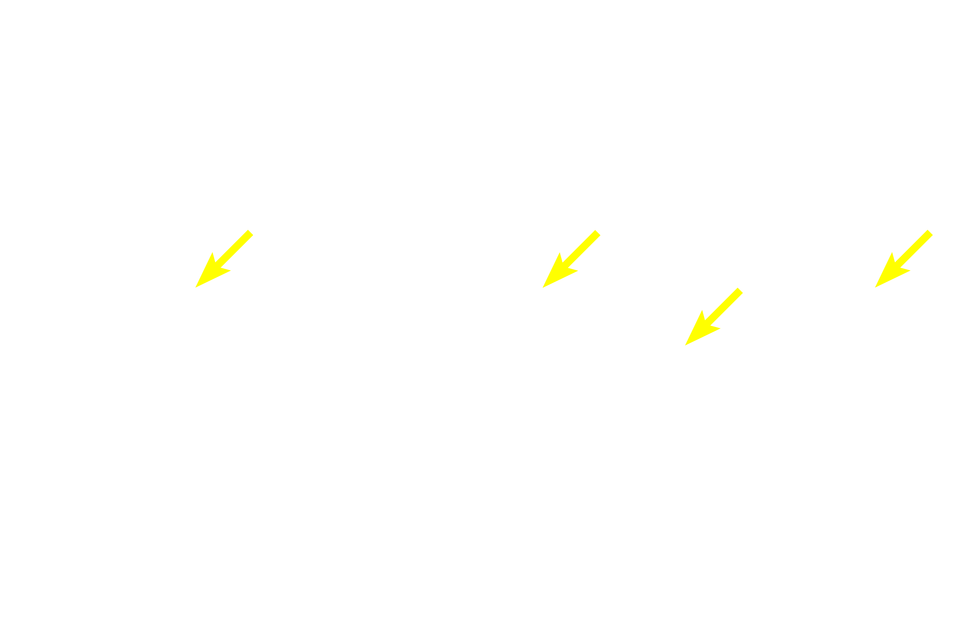  - Melanin <p>This section shows a more highly pigmented epidermis with increased melanin in the stratum basale cells.  Melanocytes, identified by their clear cytoplasm and heterochromatic nuclei, are visible among the basal cells.  The number of melanocytes remains constant across individuals with different skin tones, however their melanin-synthesizing activity varies.  Pentachrome stain,  1000x</p>
