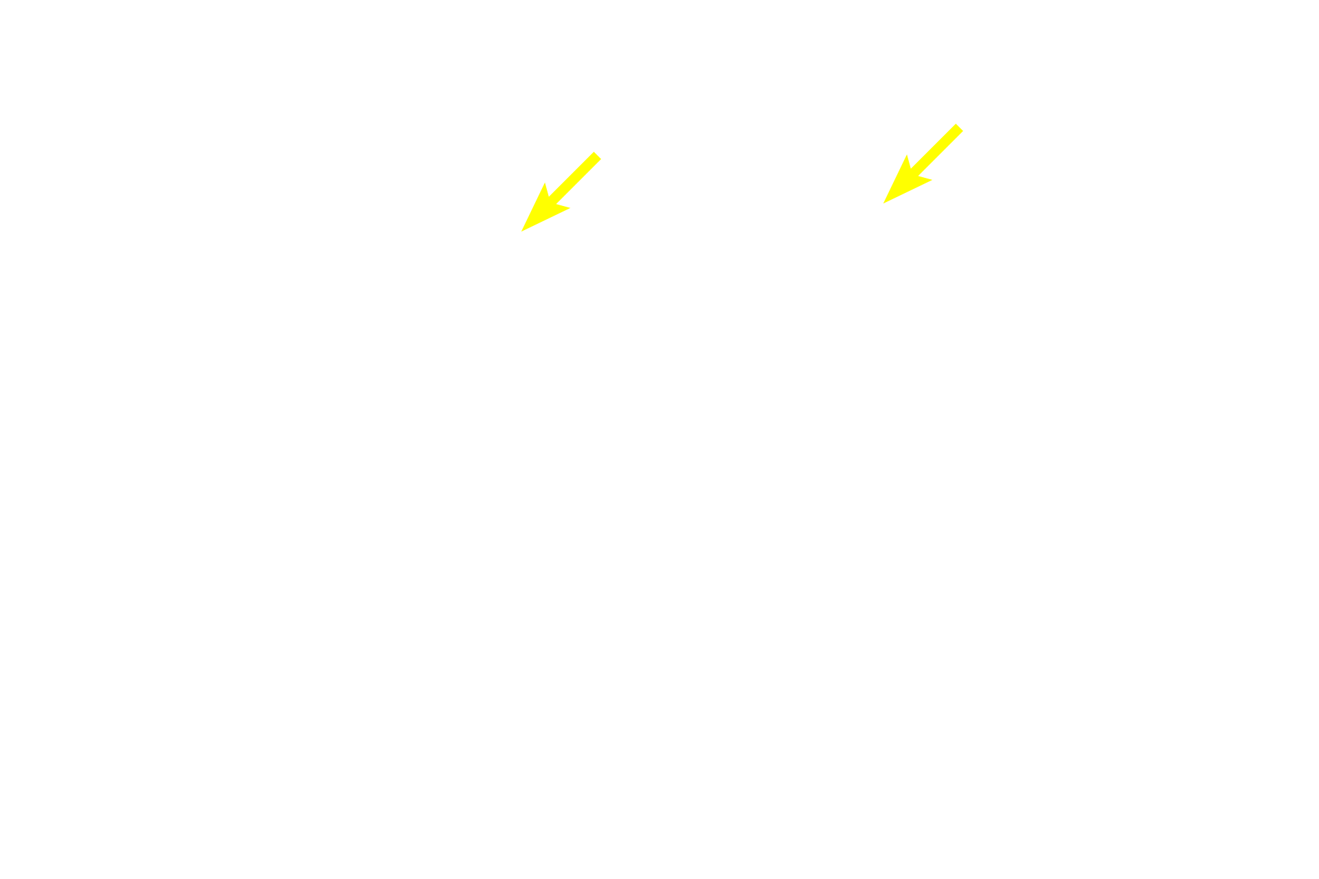 Stratum granulosum <p>This section shows a more highly pigmented epidermis with increased melanin in the stratum basale cells.  Melanocytes, identified by their clear cytoplasm and heterochromatic nuclei, are visible among the basal cells.  The number of melanocytes remains constant across individuals with different skin tones, however their melanin-synthesizing activity varies.  Pentachrome stain,  1000x</p>
