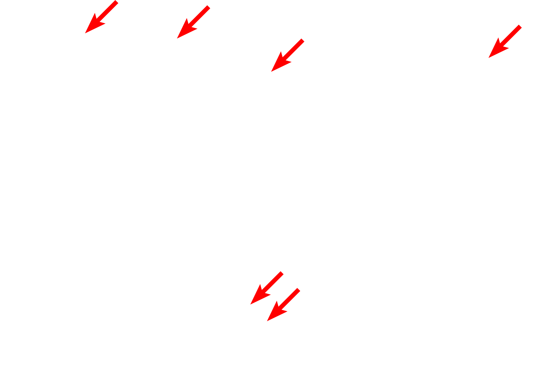  - Melanosomes <p>Melanocytes in stratum basale synthesize melanin pigment in vesicles called melanosomes. Once formed, these vesicles migrate into melanocyte processes and are transferred to neighboring keratinocytes. Once in keratinocytes, melanin distributes to a supranuclear location, blocking ultraviolet radiation.  10,000x</p>
