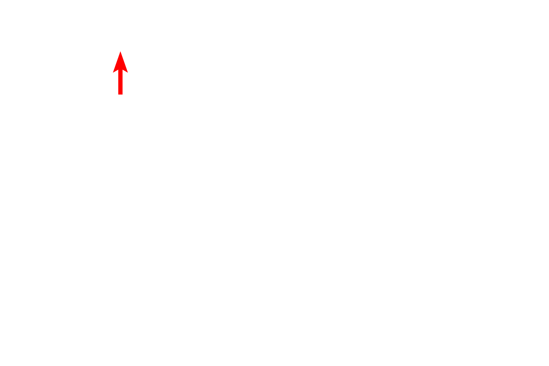  - Melanosome in keratinocyte <p>Pale-staining melanocytes contain melanosomes distributed throughout the cell. Melanosomes, containing the pigment melanin, are transferred into the neighboring keratinocytes. Tonofibrils, composed of keratin intermediate filaments (tonofilaments), can be seen in the keratinocytes of stratum basale.  15,000x</p>

