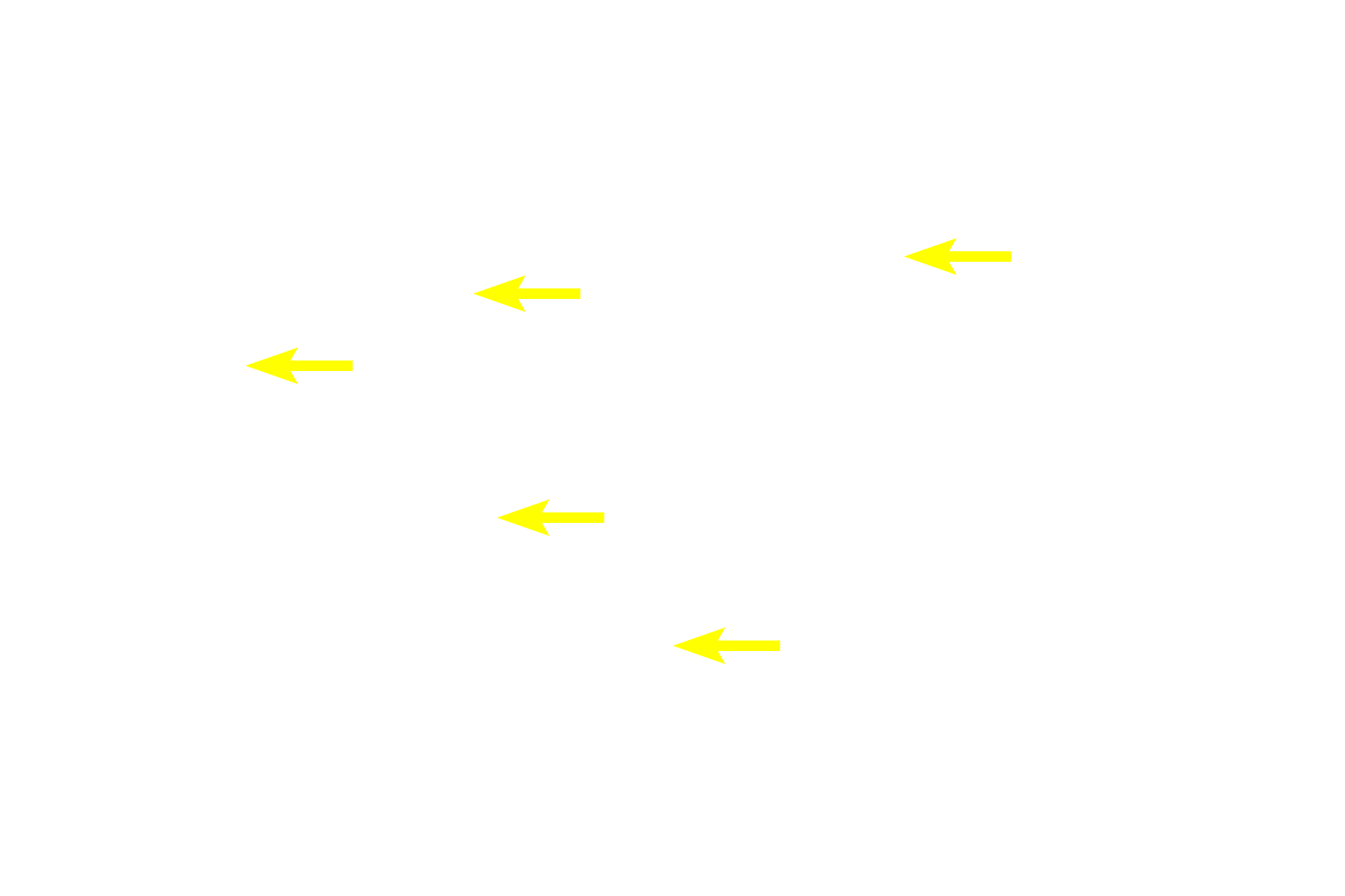  - Connective tissue <p>The lobule, the basic structure of the liver, is formed by anastomosing rows of hepatocytes and intervening sinusoids, which extend from the periphery of the lobule toward a central vein. Portal canals, located at the marginal angles around the perimeter of the lobule, contain branches of the hepatic portal vein, hepatic artery and bile duct. This image of pig liver shows bands of connective tissue outlining lobules; these distinctions are not so obvious in the human. </p>

