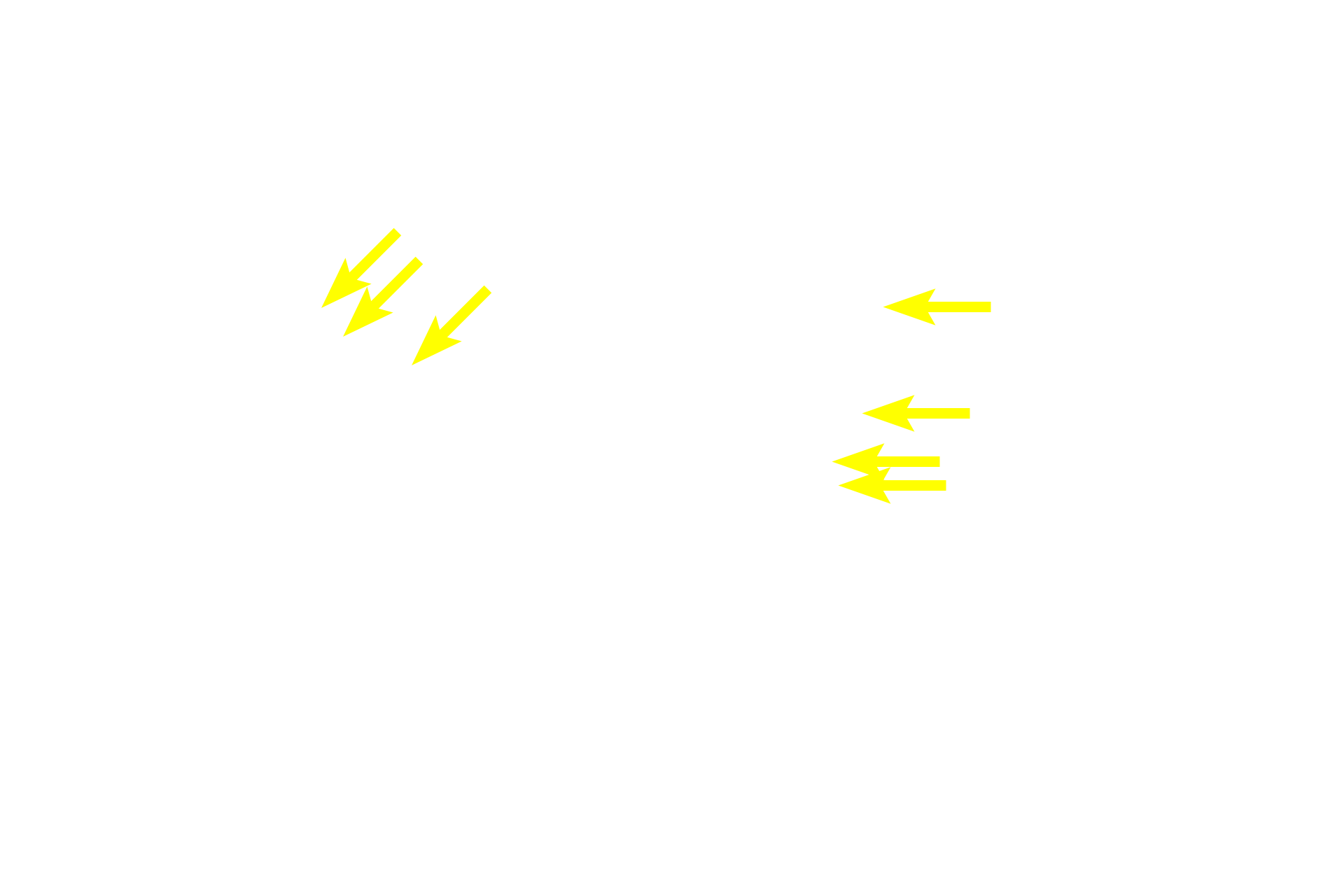 Sinusoids <p>The classic liver lobule is more clearly demarcated by connective tissue in a pig than in the human.  Blood enters the liver in the hepatic portal vein or hepatic artery; branches of both vessels are located in a portal canal.  From these branches, blood enters hepatic sinusoids between plates of hepatocytes and is carried into the central vein.  Bile is produced by the hepatocytes and flows in bile canaliculi toward the periphery of the lobule where it enters branches of the bile duct.  100x</p>
