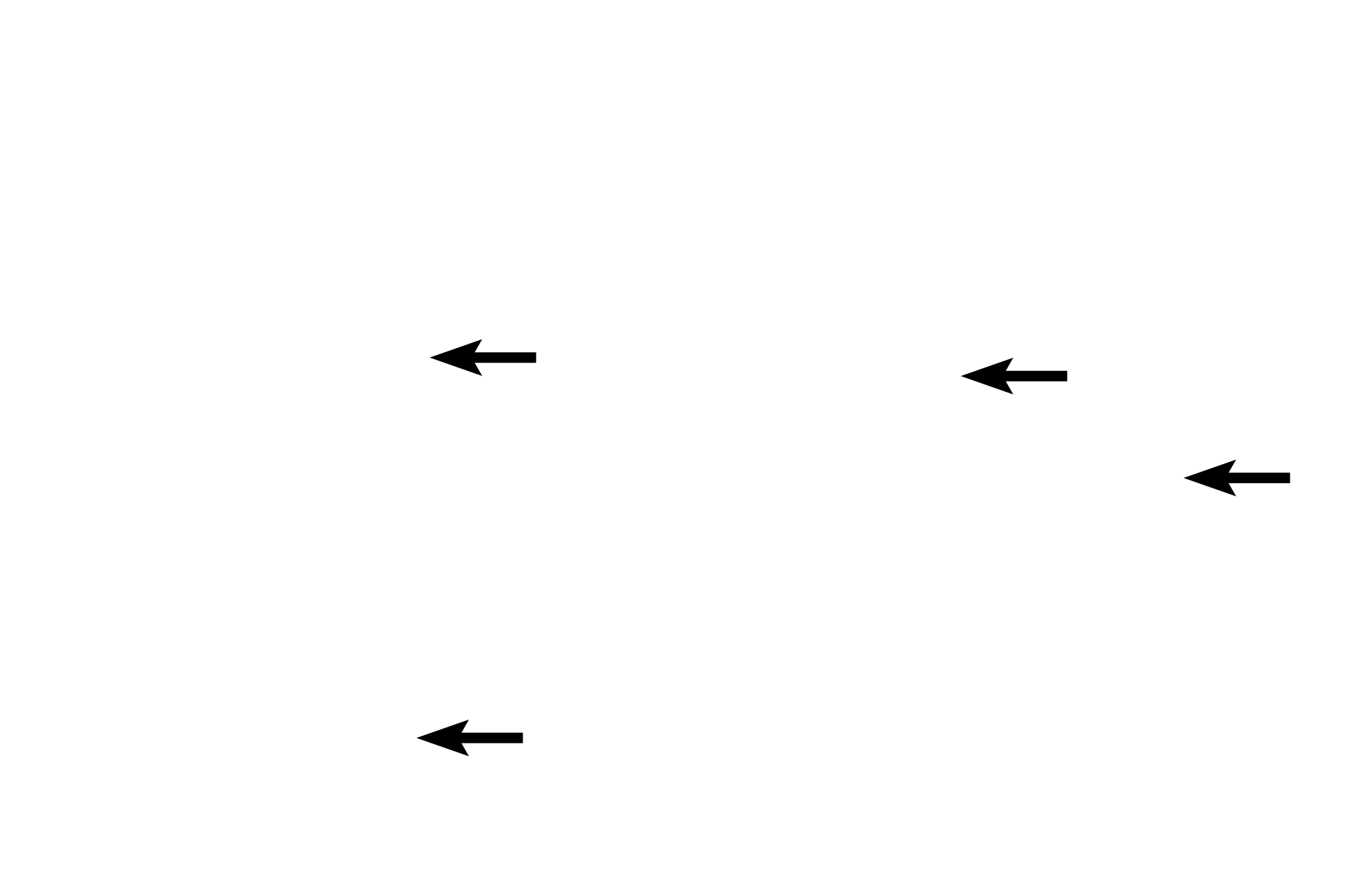 Hepatic sinusoids <p>Sinusoids are discontinuous capillaries that separate plates of hepatocytes. Kupffer cells, spanning the lumen of these sinusoids, are a type of macrophage that phagocytose aging red blood cells and other debris in the sinusoidal lumen.  Like other macrophages, their cytoplasm contains large numbers of lysosomes and often appears vacuolated and lacy.  1000x</p>
