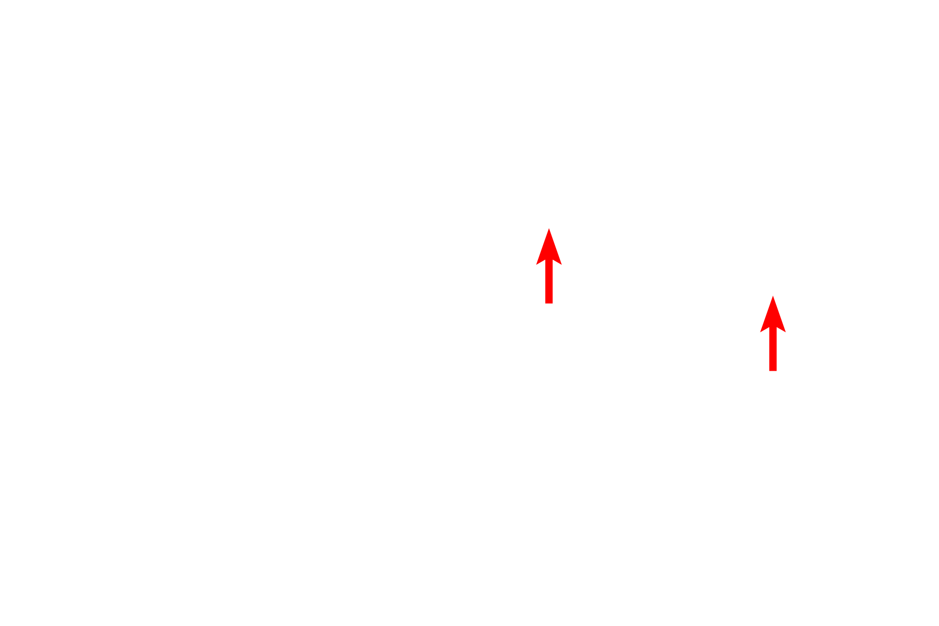 Kupffer cell <p>Sinusoids, discontinuous capillaries, are lined by a fenestrated endothelium with additional gaps between adjacent cells.  The discontinuous basal lamina allows easy access between the sinusoid and the space of Disse, located between sinusoids and adjacent hepatocytes.  Kupffer cells (liver macrophages) span sinusoids, phagocytosing aged erythrocytes and debris.  5000x</p>
