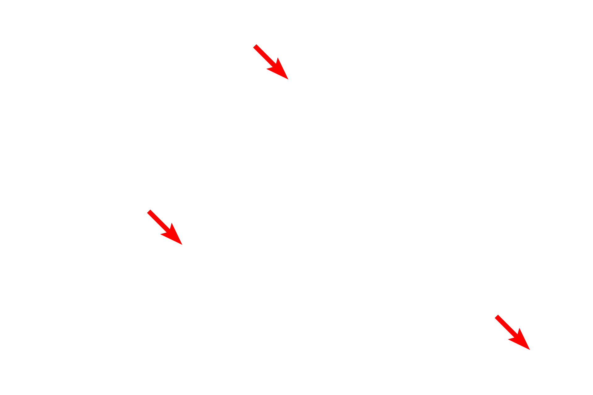 Space of Disse <p>Sinusoids, discontinuous capillaries, are lined by a fenestrated endothelium with additional gaps between adjacent cells.  The discontinuous basal lamina allows easy access between the sinusoid and the space of Disse, located between sinusoids and adjacent hepatocytes.  Kupffer cells (liver macrophages) span sinusoids, phagocytosing aged erythrocytes and debris.  5000x</p>
