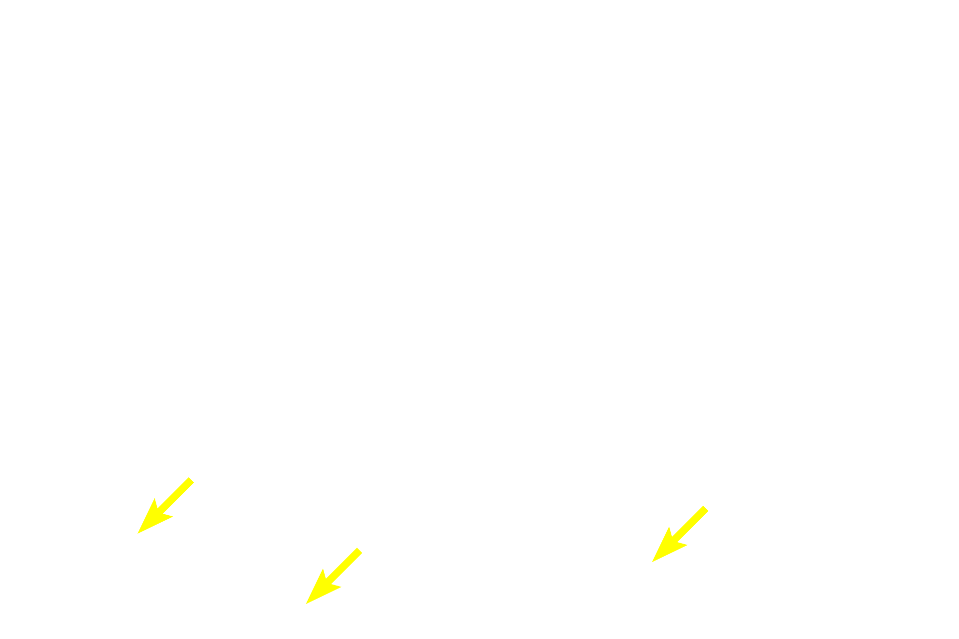  - Minor salivary gland <p>The epithelium of lining mucosa is stratified squamous moist; epithelial pegs (ridges) are short.  The lamina propria in the oral cavity, like the dermis of the skin, is subdivided into a papillary portion immediately beneath the epithelium and a reticular portion of denser connective tissue.  The submucosa, underlying the mucosa, contains minor salivary glands.  200x</p>
