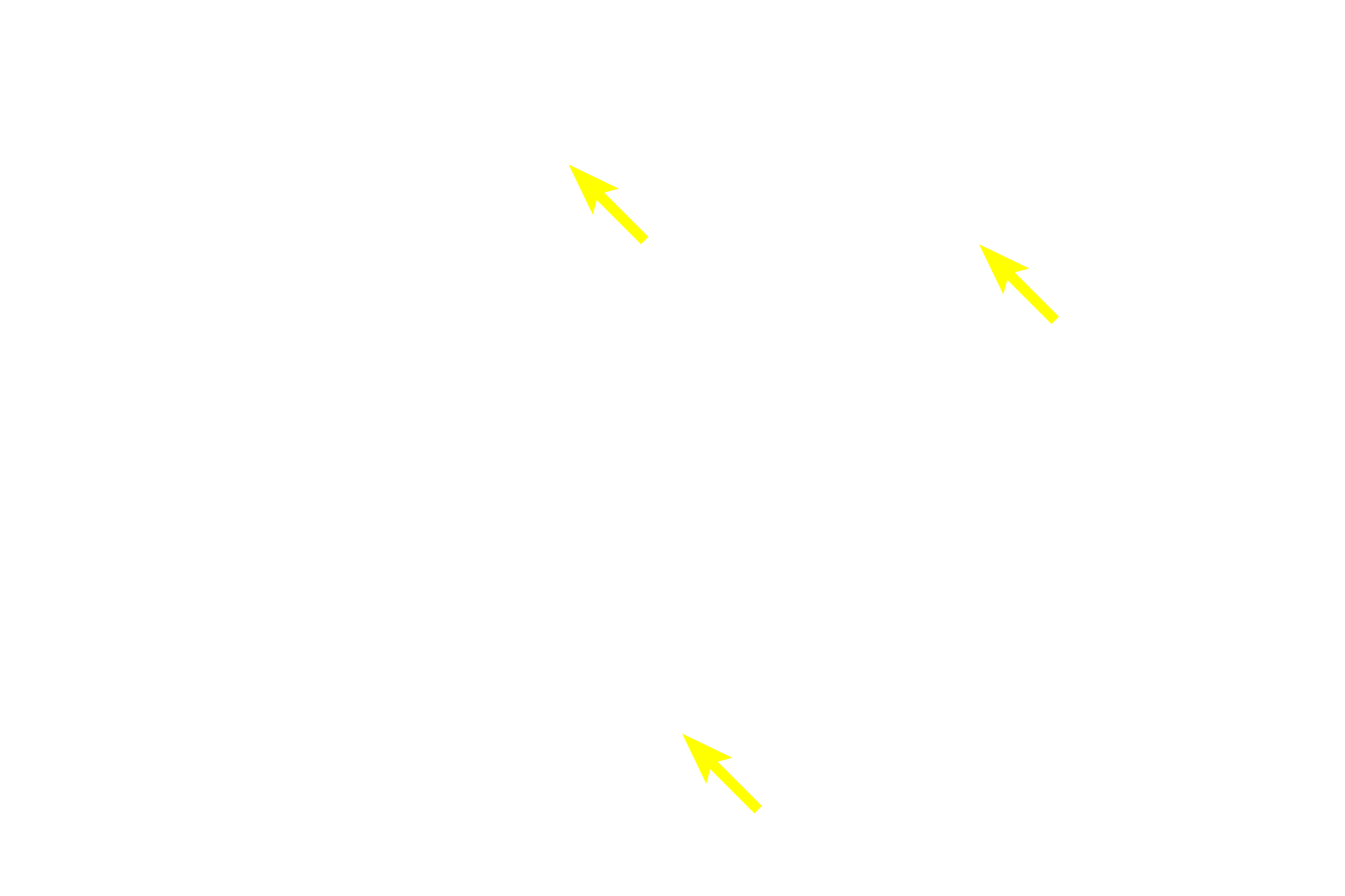Serous acini <p>The coalescing interlobular ducts seen here exit into the surrounding interlobular connective tissue.  These larger interlobular ducts are lined by a stratified epithelium, initially stratified cuboidal, that eventually transitions into stratified columnar.  300x</p>
