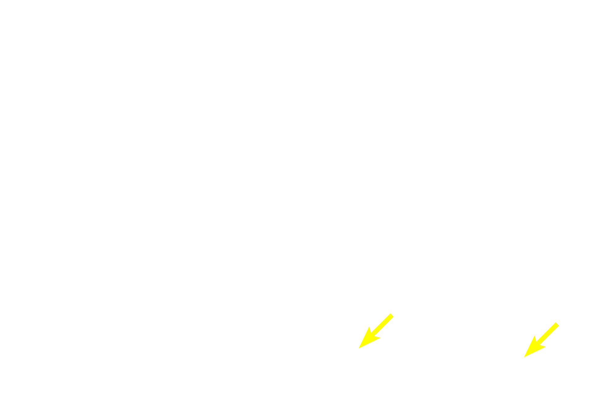Intralobular (striated) ducts <p>The coalescing interlobular ducts seen here exit into the surrounding interlobular connective tissue.  These larger interlobular ducts are lined by a stratified epithelium, initially stratified cuboidal, that eventually transitions into stratified columnar.  300x</p>
