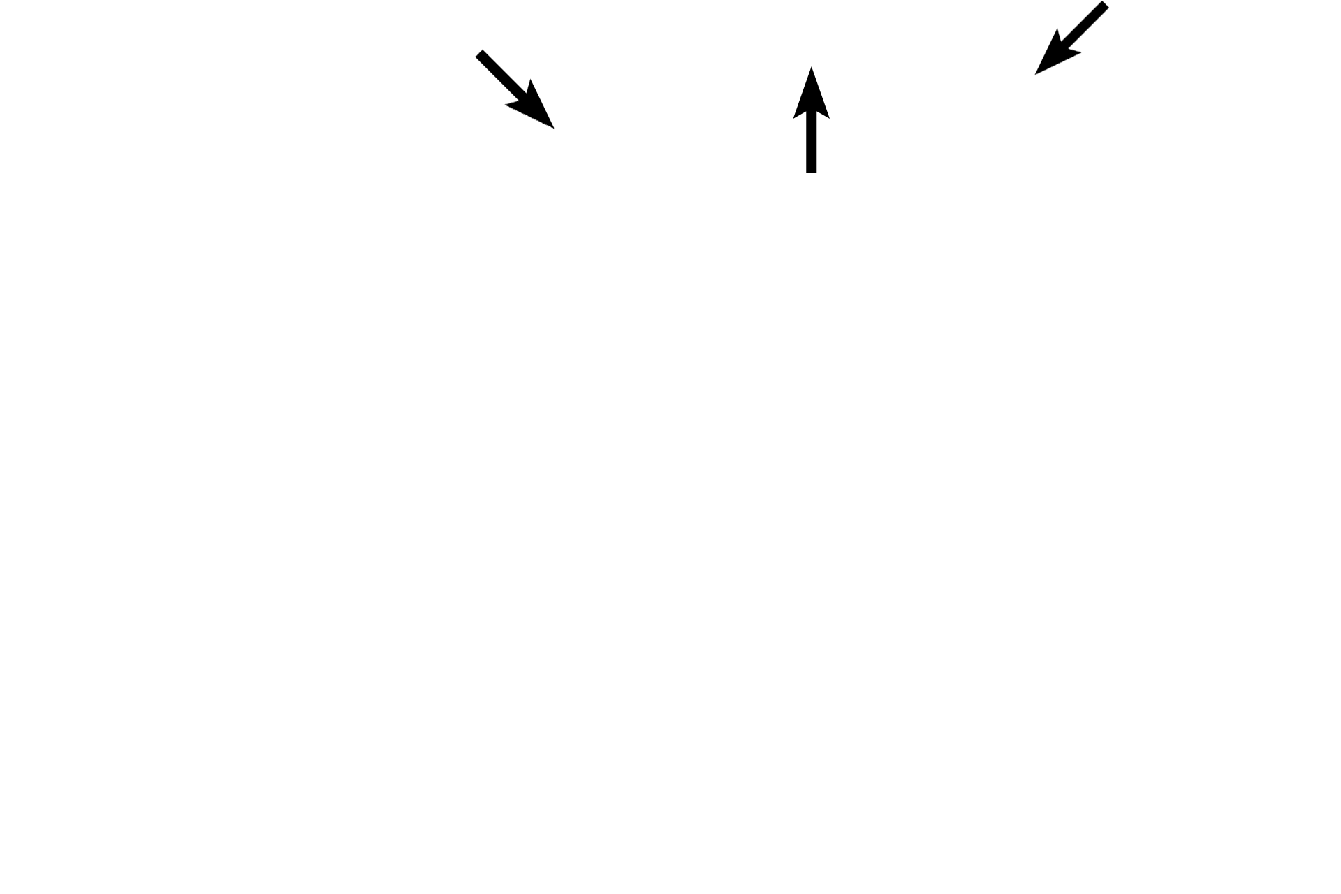 Keratinized stratified squamous epithelium <p>Eight to twelve circumvallate papillae are located along the sulcus terminalis, separating the anterior from the posterior portion of the tongue.  Each papilla is surrounded by a deep sulcus that receives ducts of the serous glands of von Ebner.  The connective tissue core is covered on its lateral surfaces with moist stratified squamous epithelium containing many taste buds.  The surface epithelium is keratinized.  40x</p>
