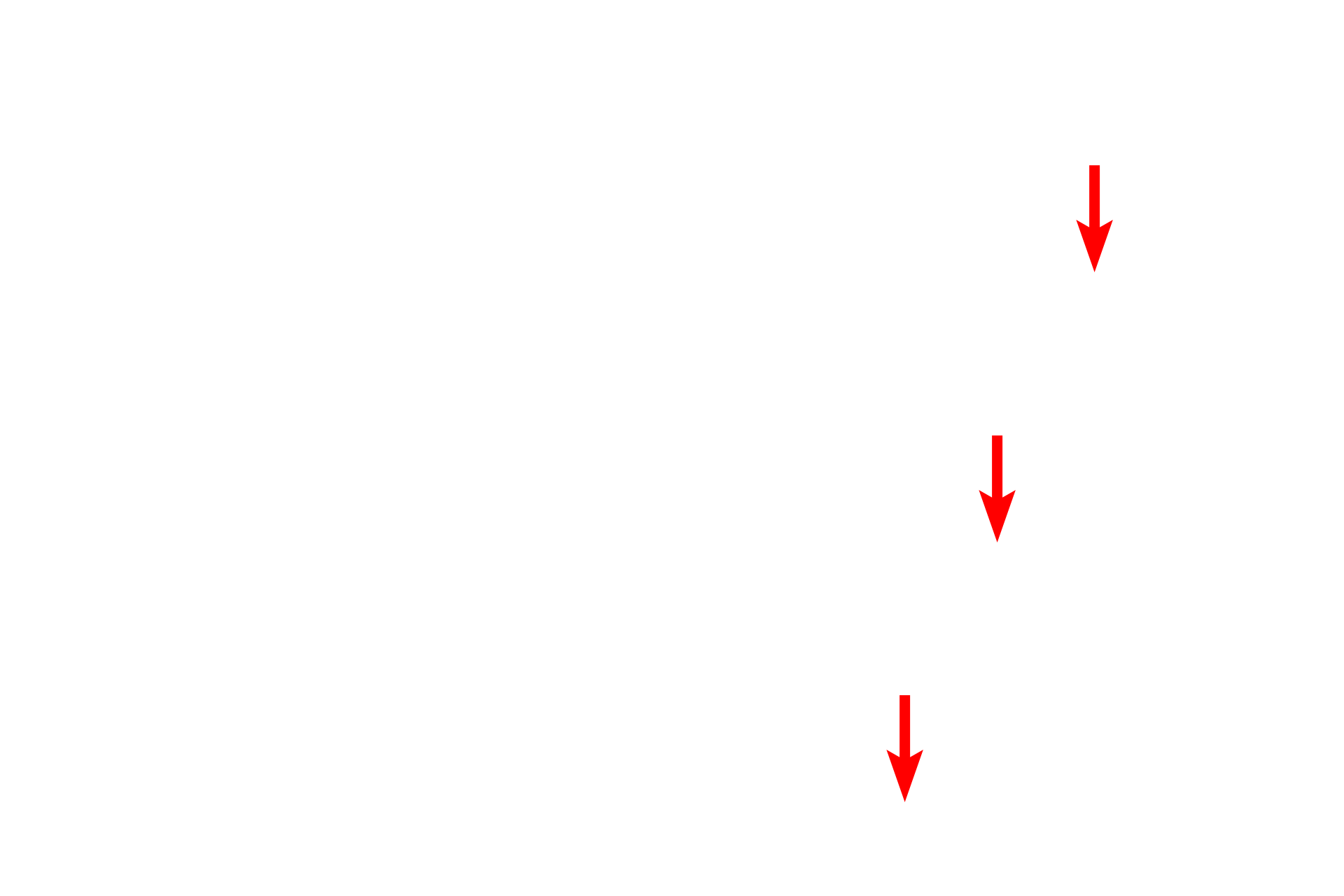Dentino-enamel junction <p>Enamel, with its growth lines or striae, appears yellow-brown in this image of ground tooth. Enamel, the hardest substance of the body, is formed by ameloblasts, lying on the surface of enamel during tooth development. These ameloblasts are lost as the tooth erupts, explaining why enamel is not formed after tooth eruption. A portion of the dentin is seen in the lower right corner. 200x</p>
